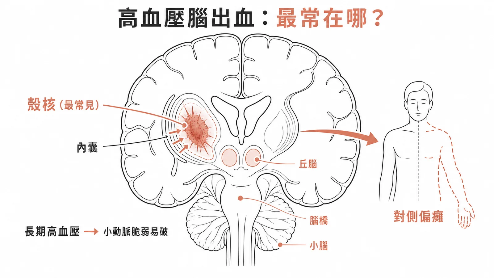 高血壓性腦出血好發位置:殼核最常見,壓迫內囊導致對側偏癱