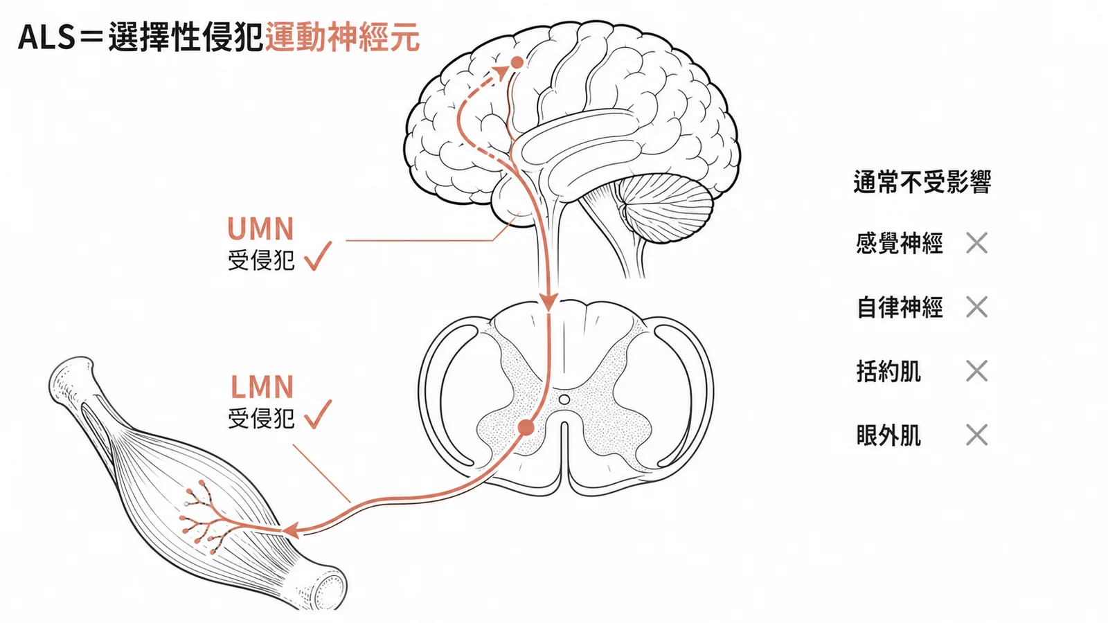 ALS選擇性侵犯運動神經元示意圖：UMN與LMN受侵犯，感覺神經、自律神經、括約肌、眼外肌通常不受影響