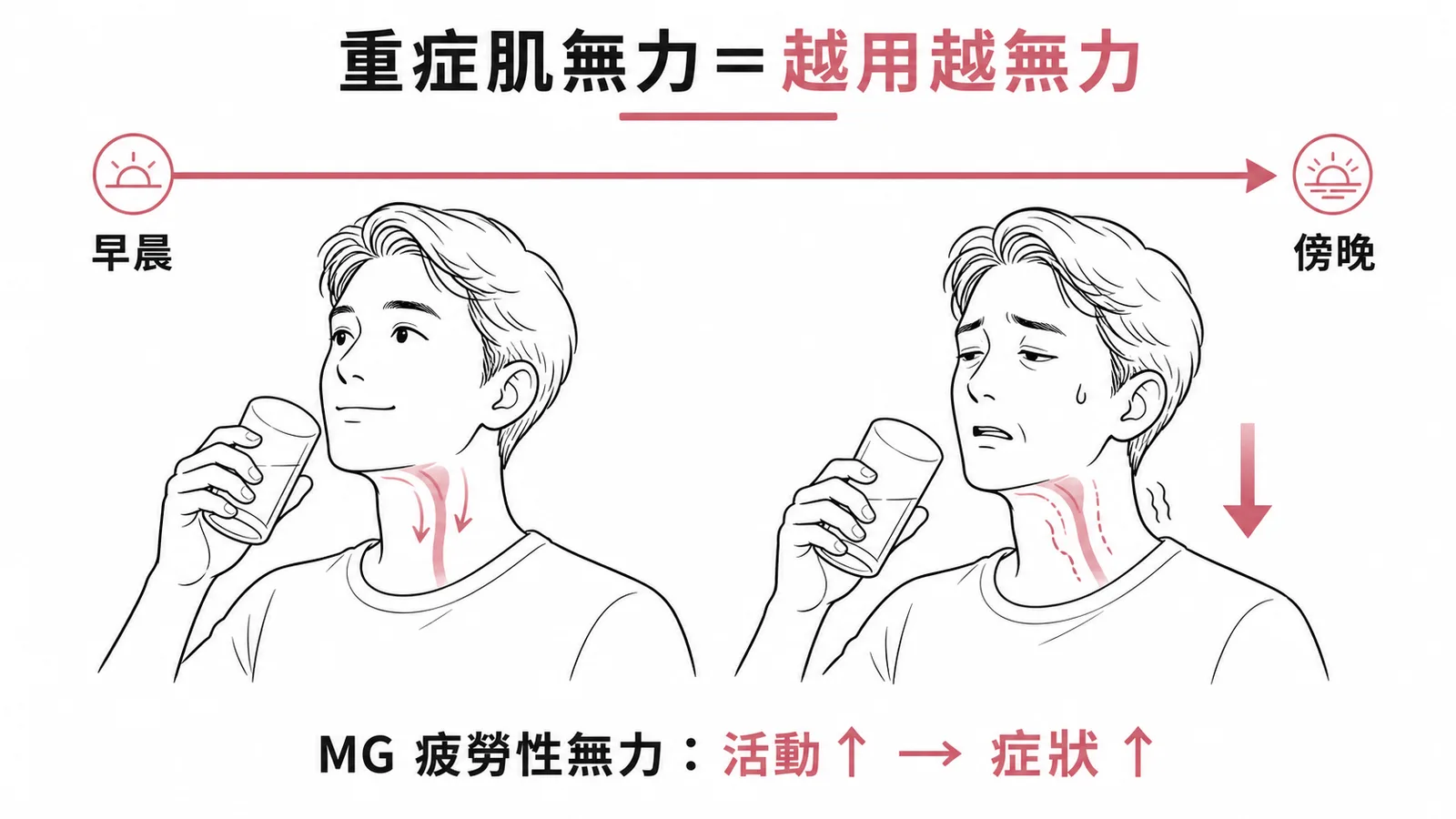 重症肌無力疲勞性無力示意圖:早晨肌力尚好、傍晚越用越無力,活動增加則症狀加重