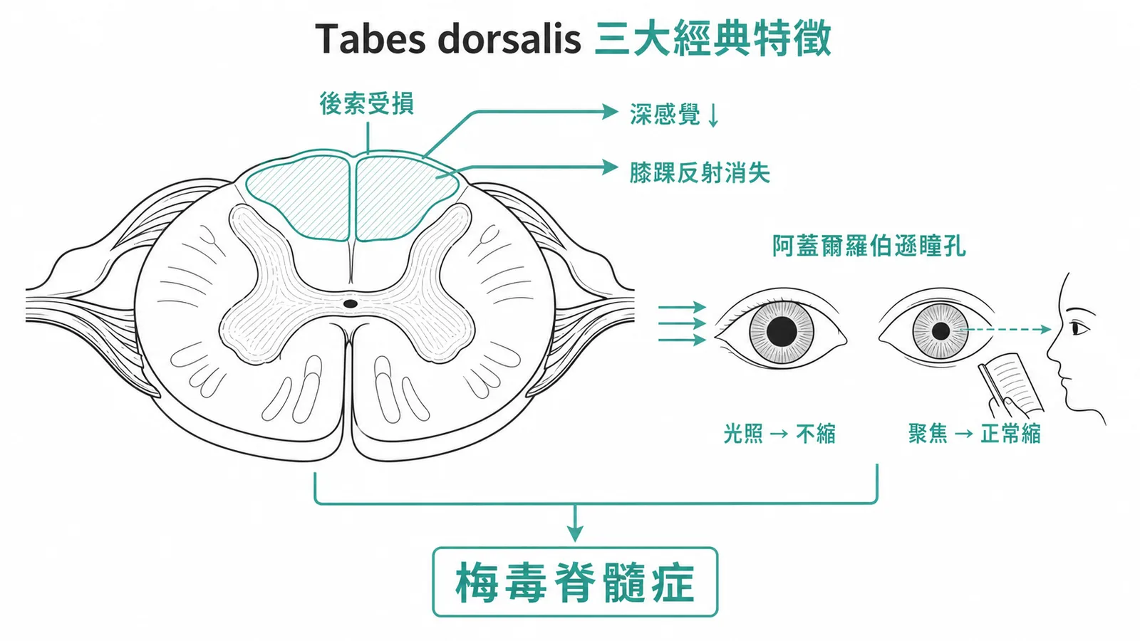 梅毒脊髓症三大經典特徵:脊髓後索受損致深感覺喪失與共濟失調、反射消失、Argyll Robertson瞳孔