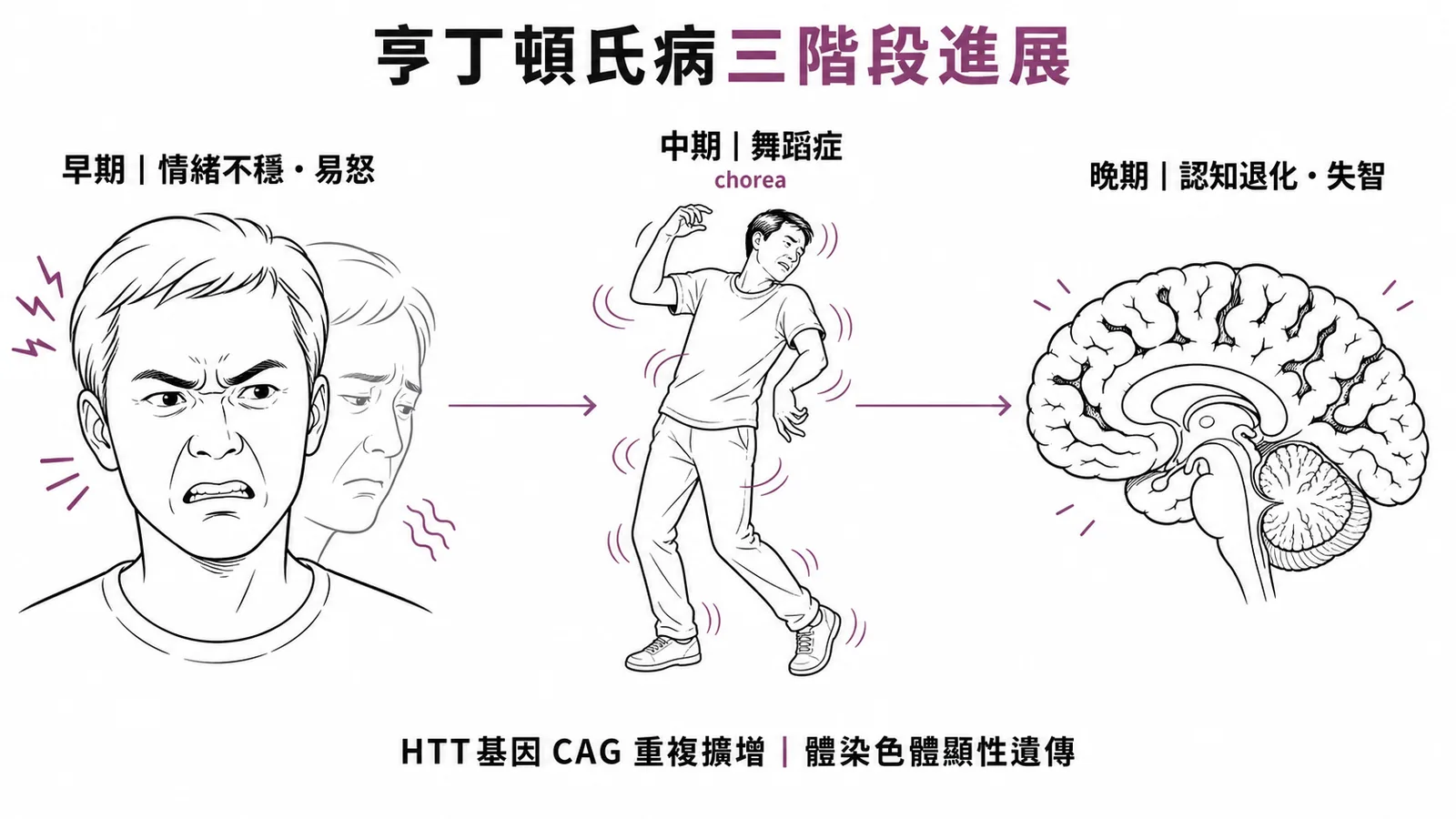 亨丁頓氏病三階段進展:早期情緒不穩、中期舞蹈症、晚期認知退化失智,HTT基因CAG重複擴增顯性遺傳
