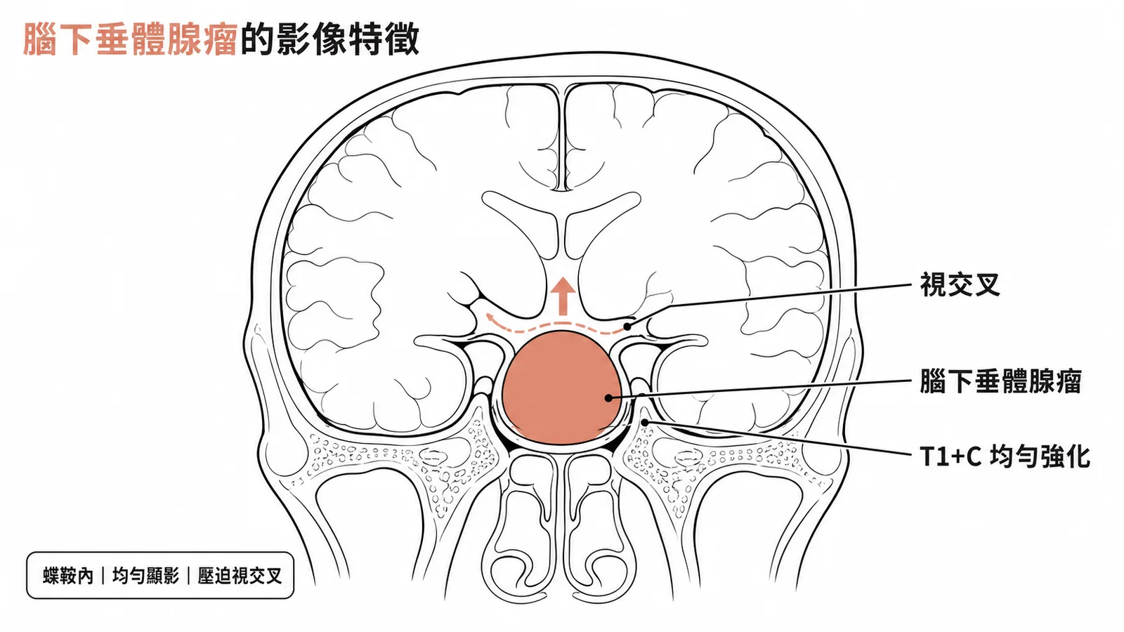 腦下垂體腺瘤影像特徵：位於蝶鞍區、T1+C均勻強化顯影、向上壓迫視交叉
