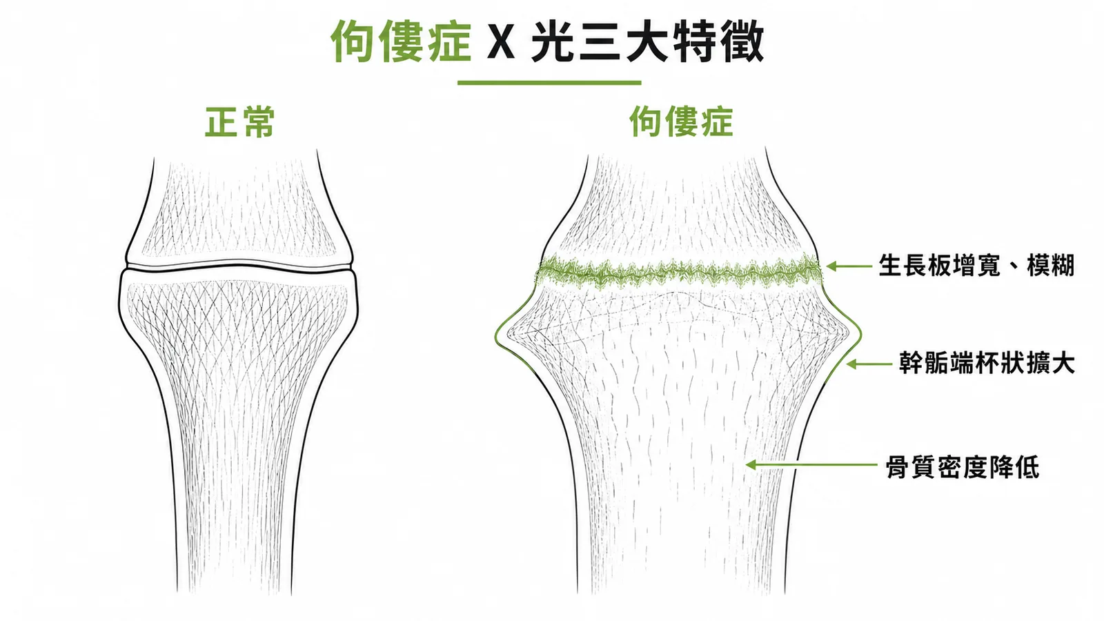 佝僂症X光三大特徵：生長板增寬模糊、幹骺端杯狀擴大、骨質密度降低