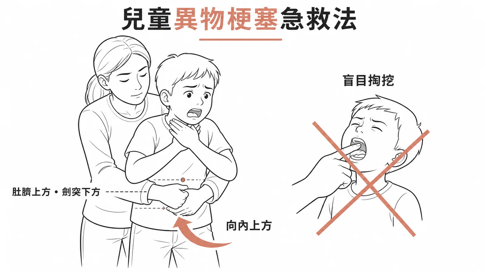 兒童異物梗塞急救：意識清醒兒童施行哈姆立克法腹部衝擊，禁止盲目掏挖