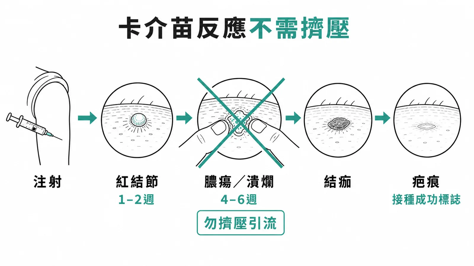 卡介苗接種後自然反應時程示意圖