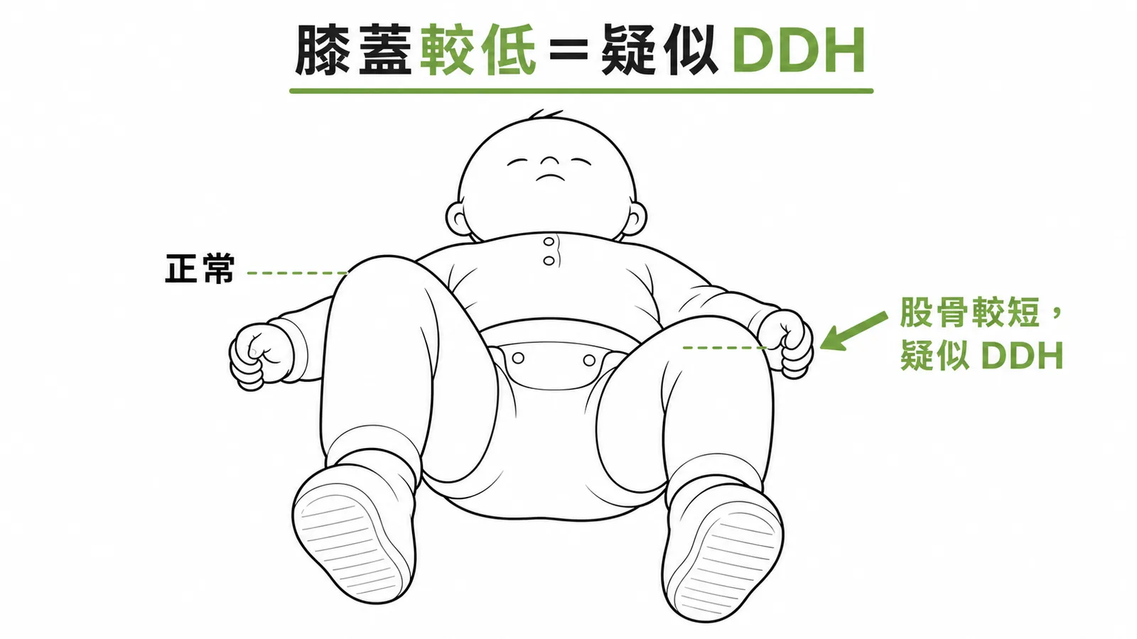 Galeazzi sign 膝蓋較低側為疑似DDH示意圖