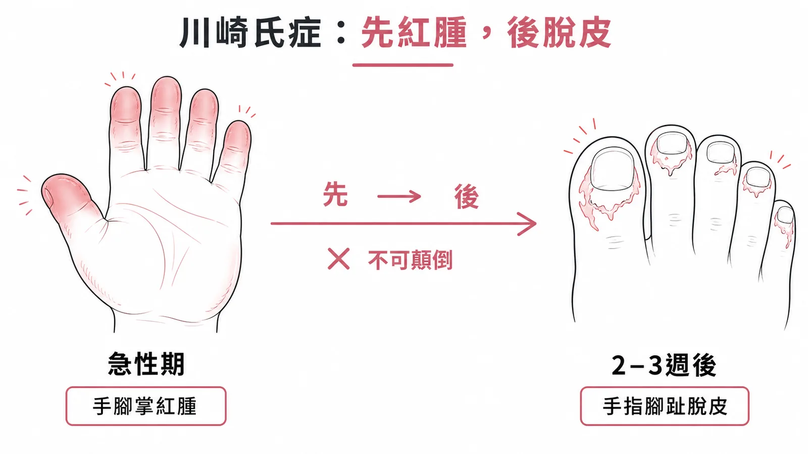 川崎氏症肢端變化順序示意圖