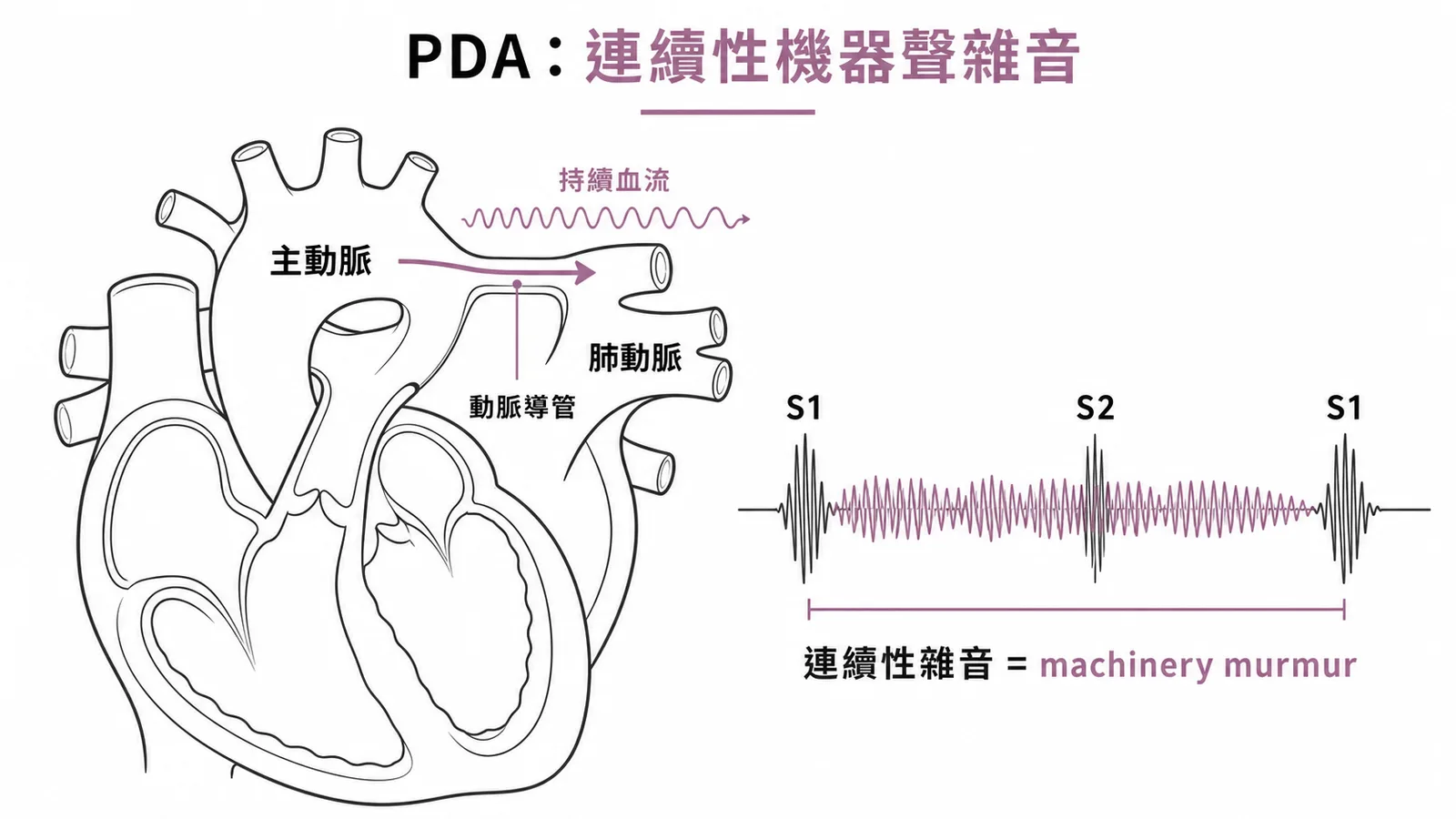 PDA連續性機器聲雜音示意圖