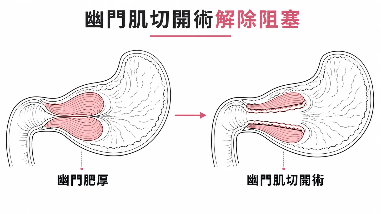 肥厚性幽門狹窄：幽門肌切開術前後對比示意圖