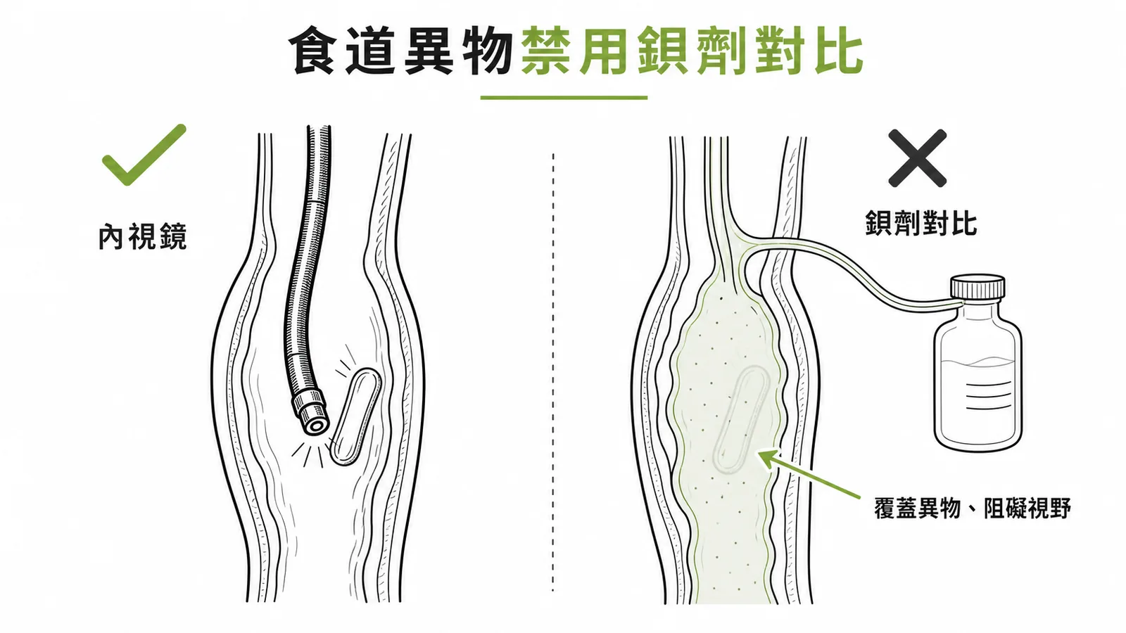 食道異物診斷：內視鏡優先，禁用鋇劑對比