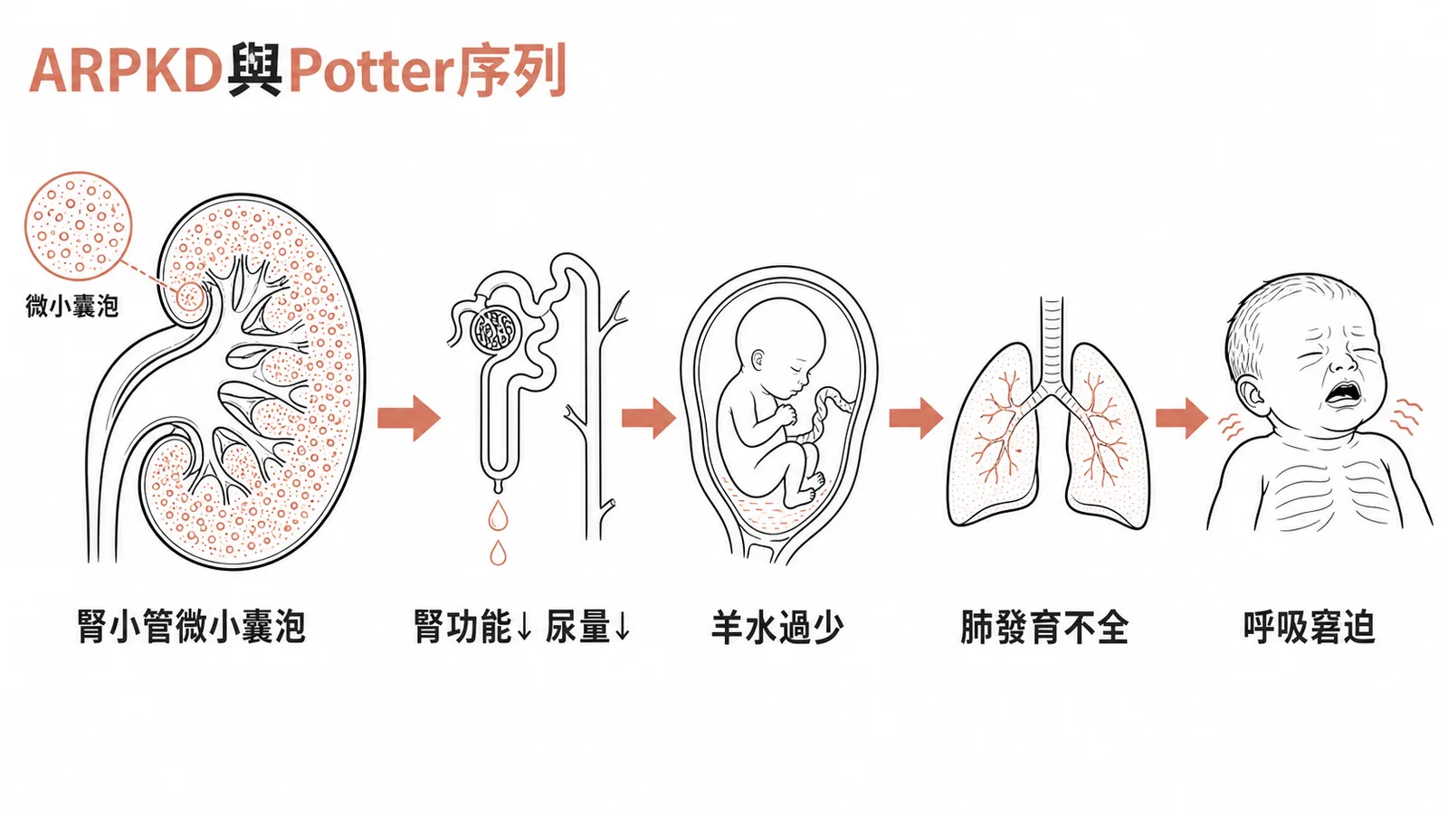 ARPKD與Potter序列：腎小管微小囊泡→尿量減少→羊水過少→肺發育不全→呼吸窘迫