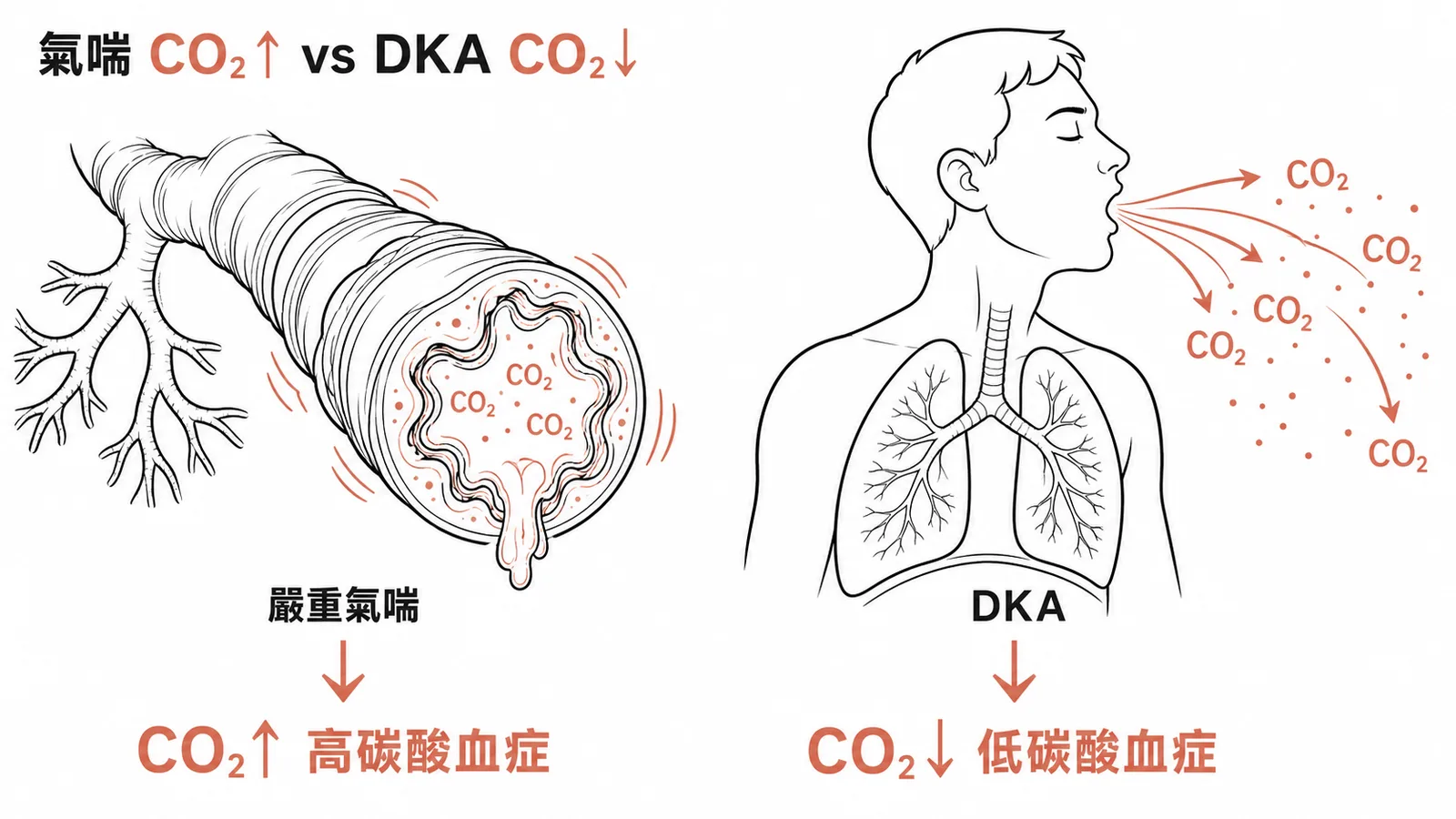 嚴重氣喘CO2升高vs DKA的CO2降低對比