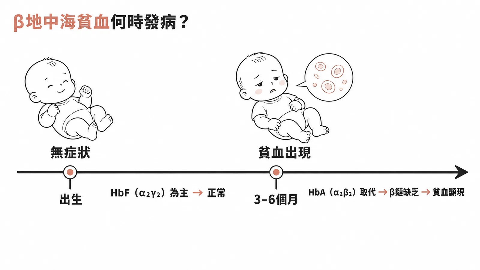 β型地中海貧血發病時間：出生時無症狀，3-6個月HbF轉HbA後貧血顯現