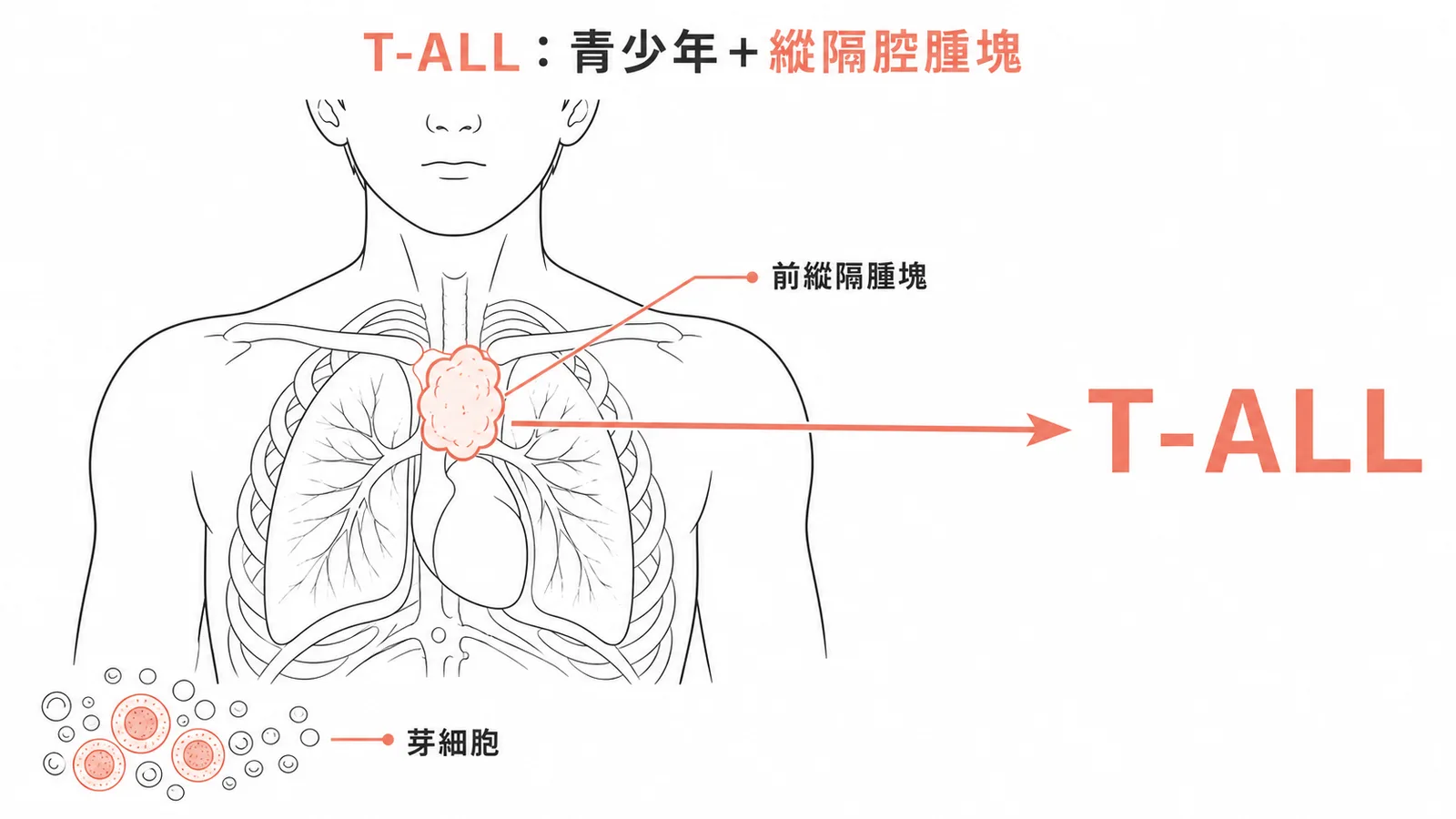 T-ALL:青少年男性合併縱隔腔腫塊與芽細胞的典型表現