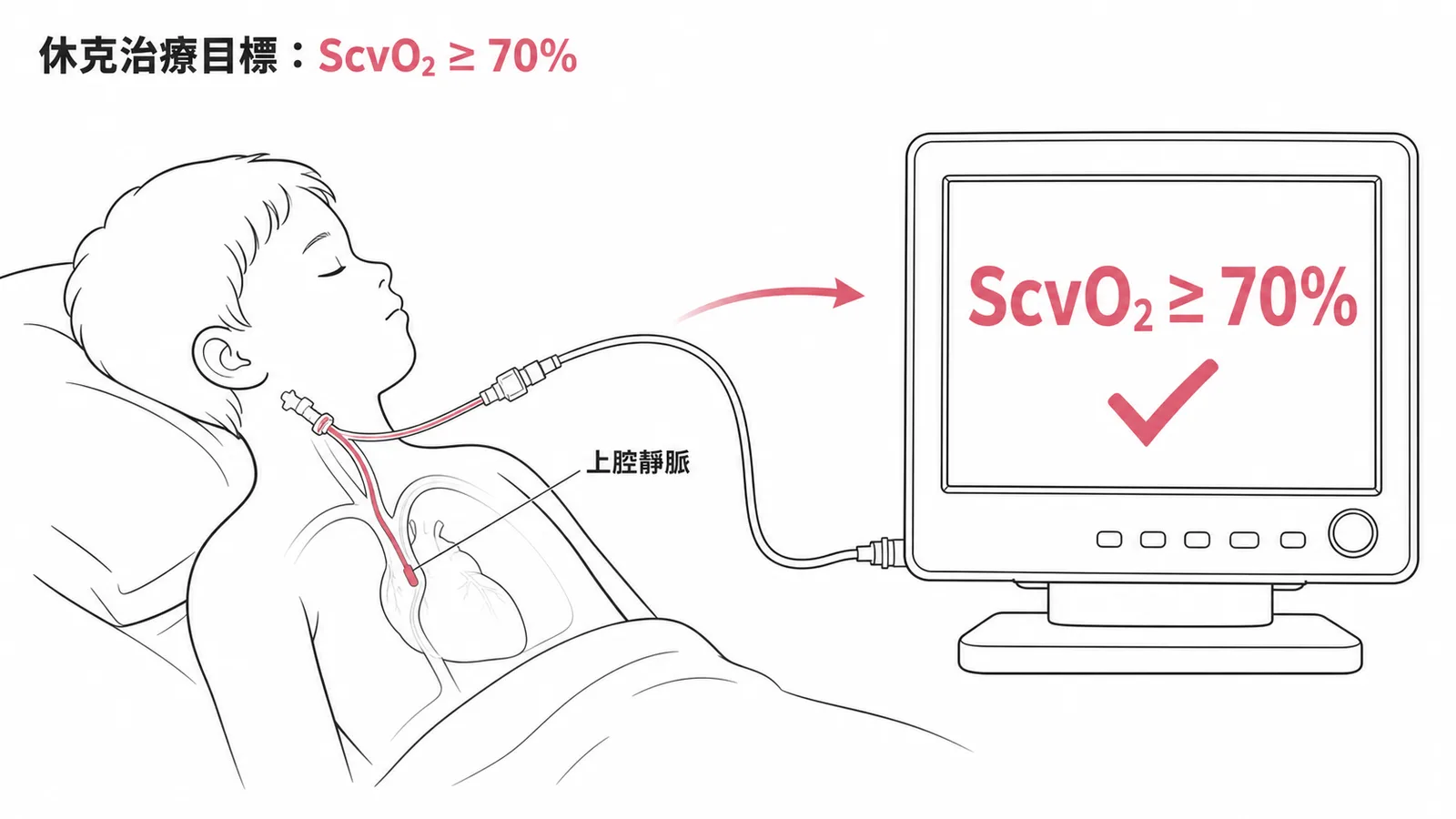 兒童休克初期治療目標為中央靜脈血氧飽和濃度ScvO2達70%以上