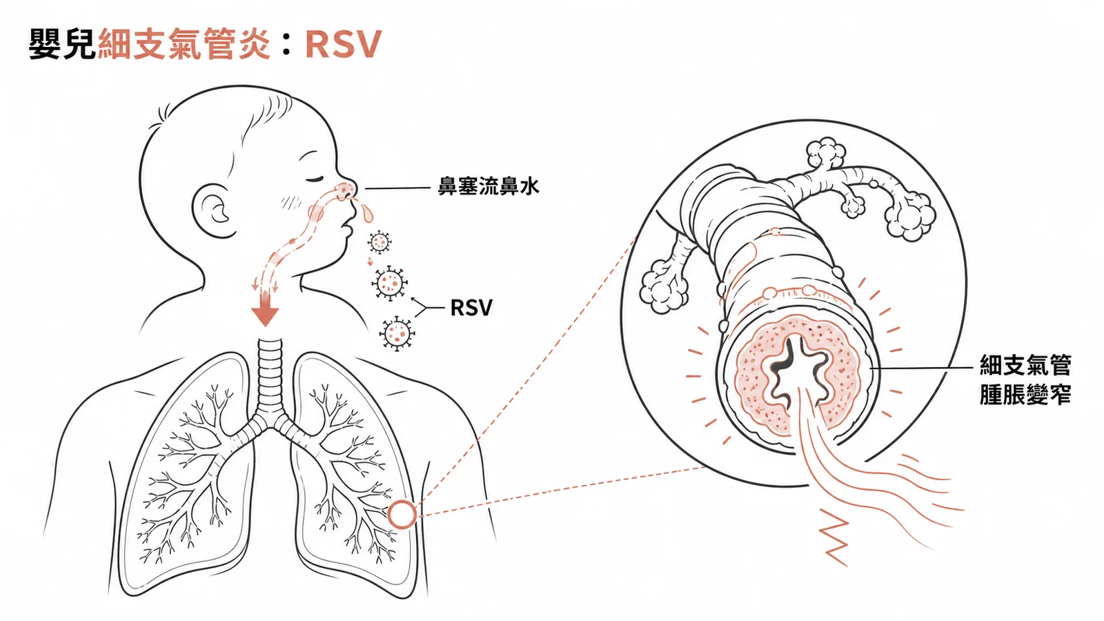嬰兒RSV細支氣管炎從上呼吸道症狀進展至細支氣管腫脹變窄