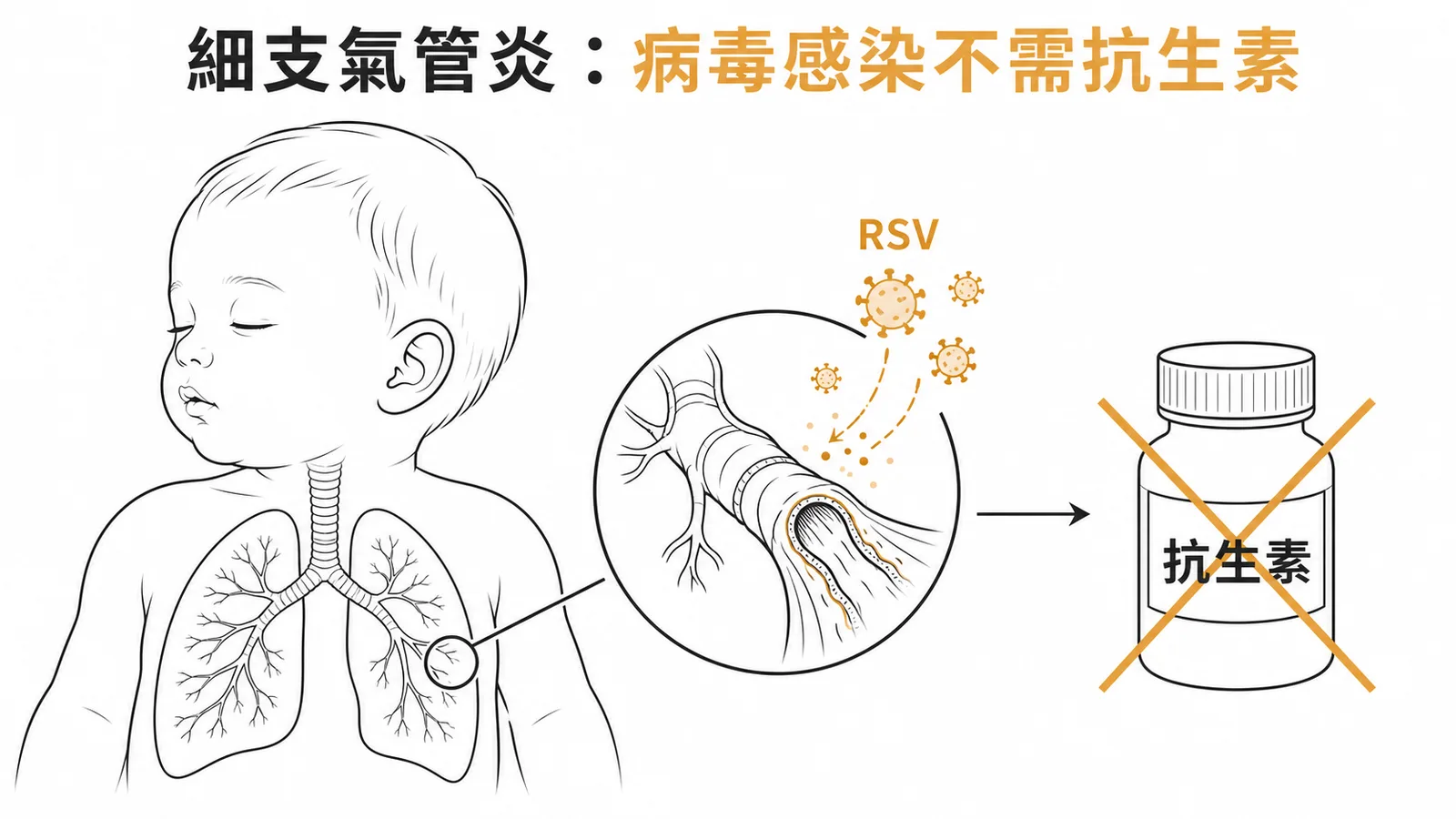 急性細支氣管炎為RSV病毒感染不需常規使用抗生素