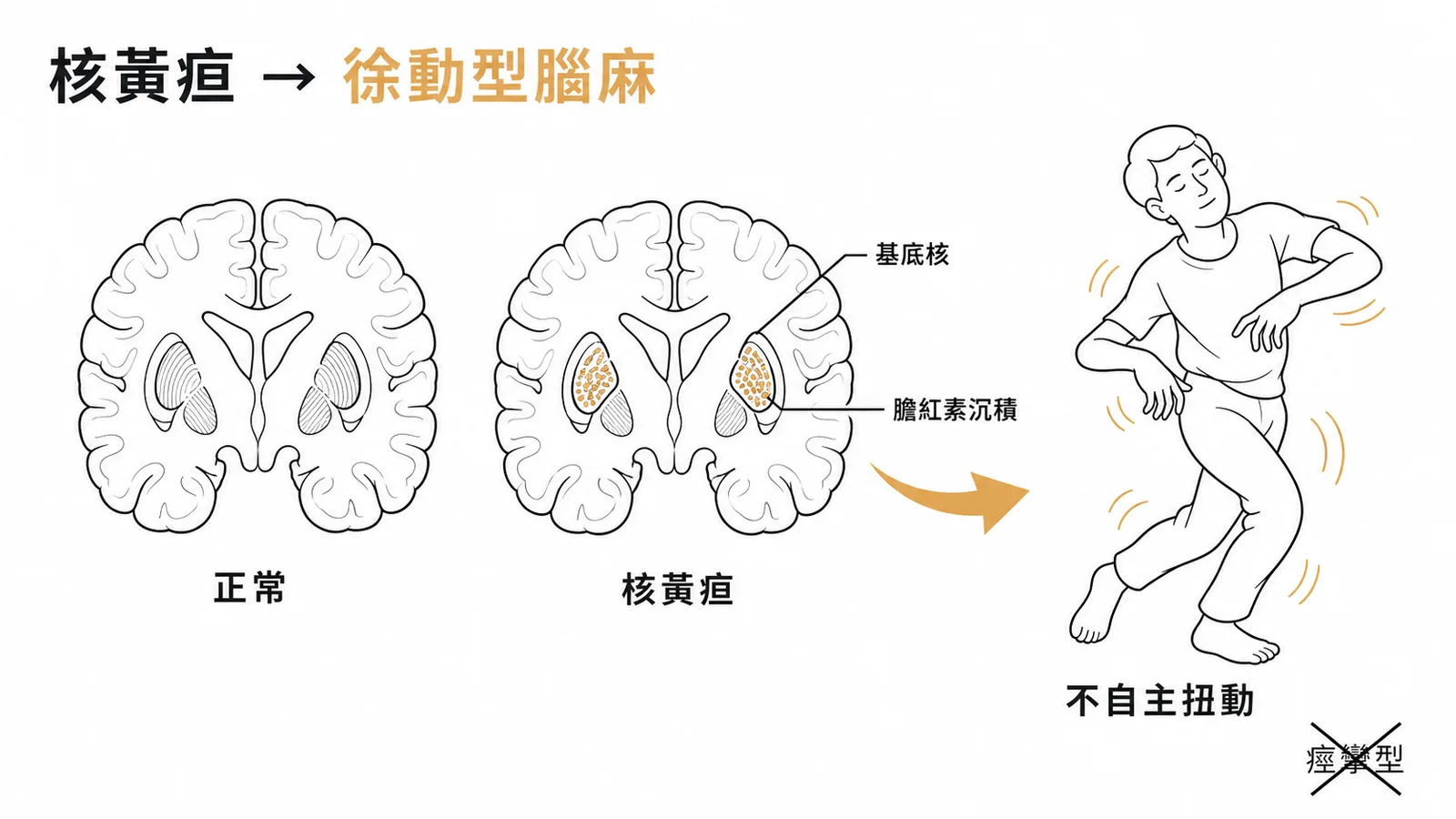 核黃疸損害基底核導致徐動型腦性麻痺的示意圖