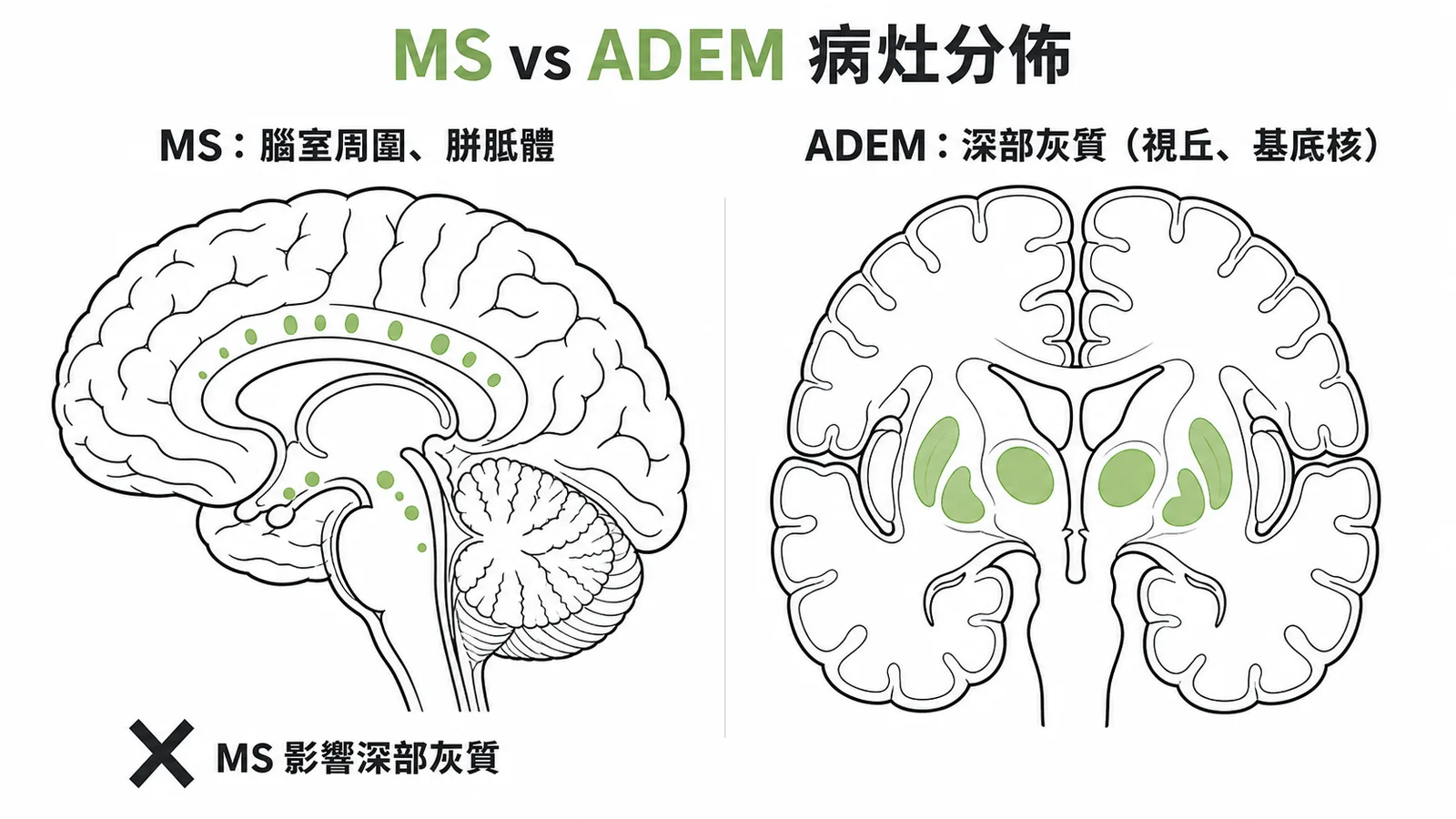 MS與ADEM在MRI上病灶分佈差異的對照圖
