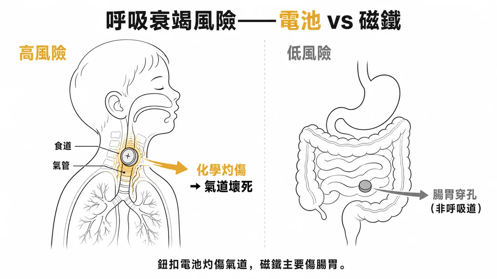 鈕扣電池灼傷氣道為高風險而磁鐵主要傷腸胃為低呼吸風險的對照圖