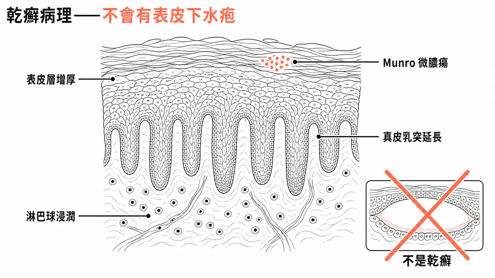 乾癬典型病理特徵與表皮下水疱非乾癬的對照圖