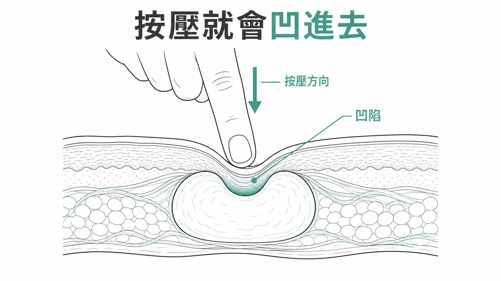 Buttonhole sign：手指按壓神經纖維瘤凹陷示意圖