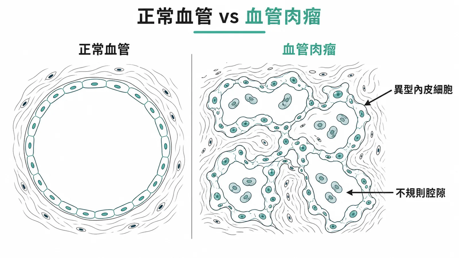 正常血管與血管肉瘤病理對照示意圖