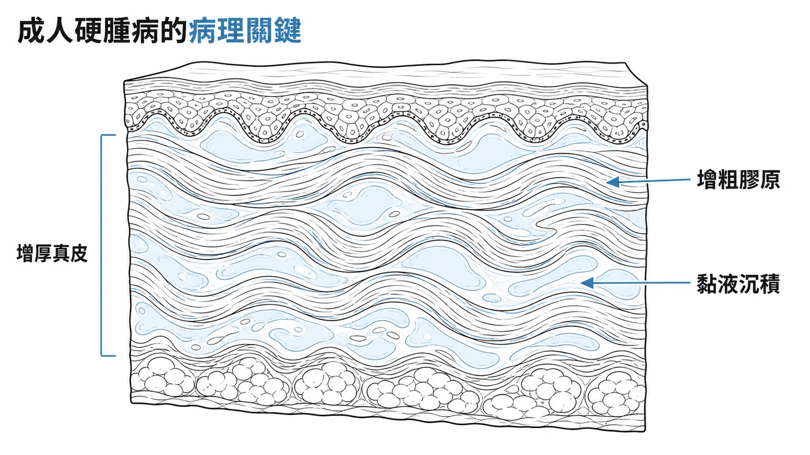 成人硬腫病病理示意:增粗膠原纖維束與黏液沉積
