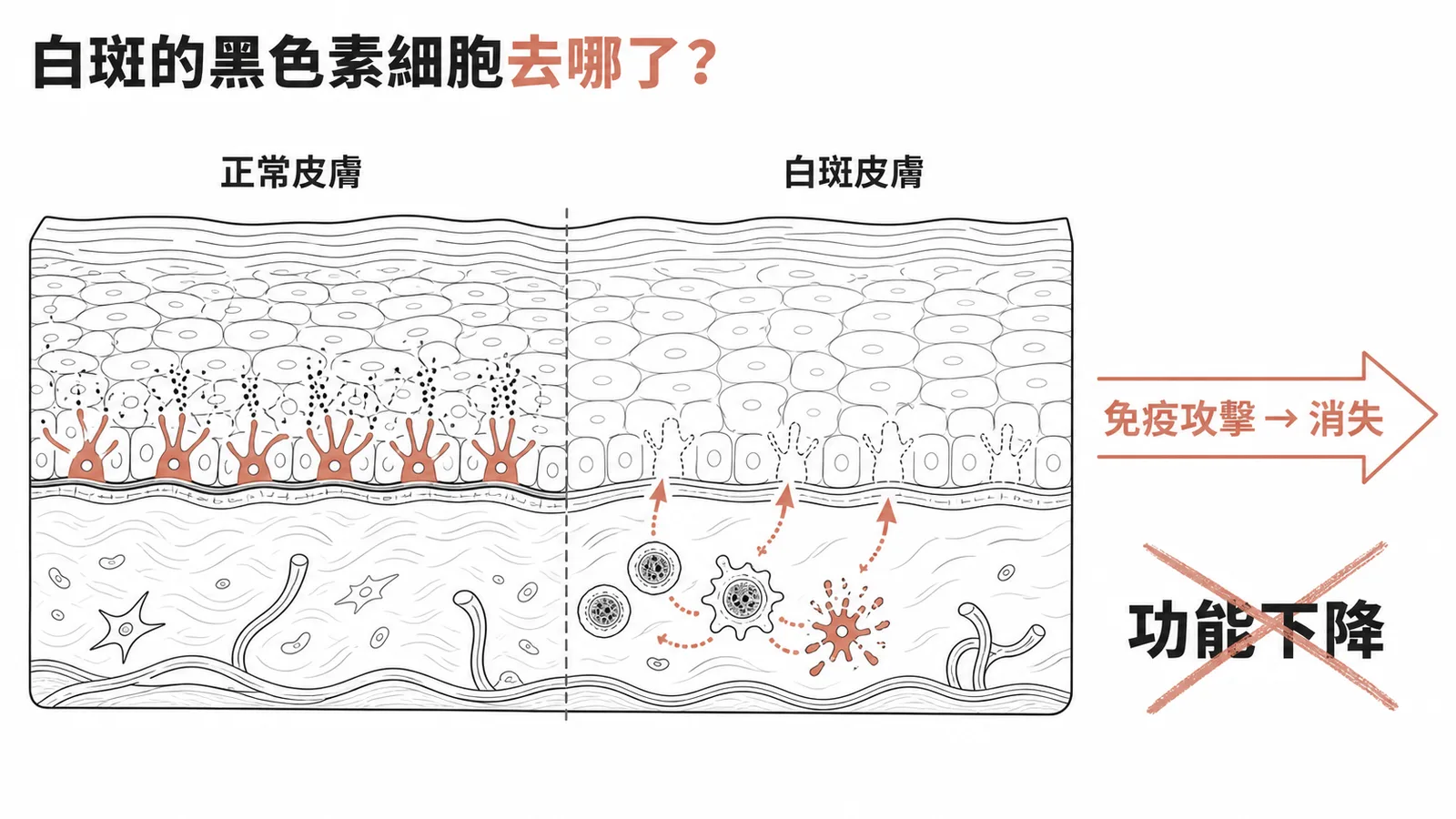 白斑成因：黑色素細胞被免疫攻擊消失而非功能下降