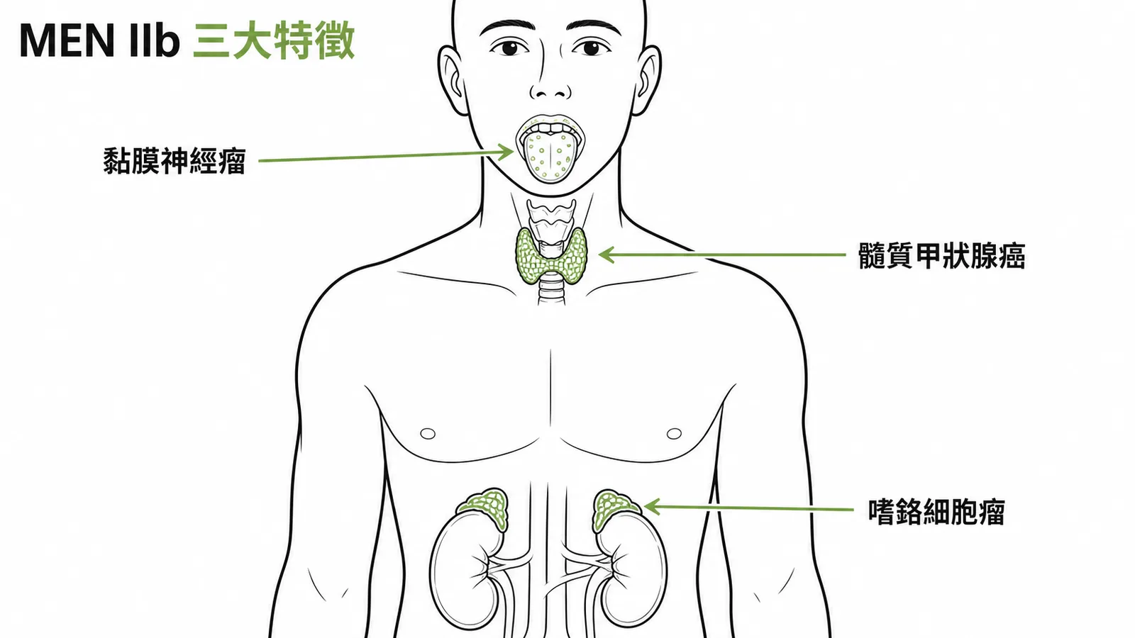 MEN IIb 三大特徵：黏膜神經瘤、髓質甲狀腺癌、嗜鉻細胞瘤