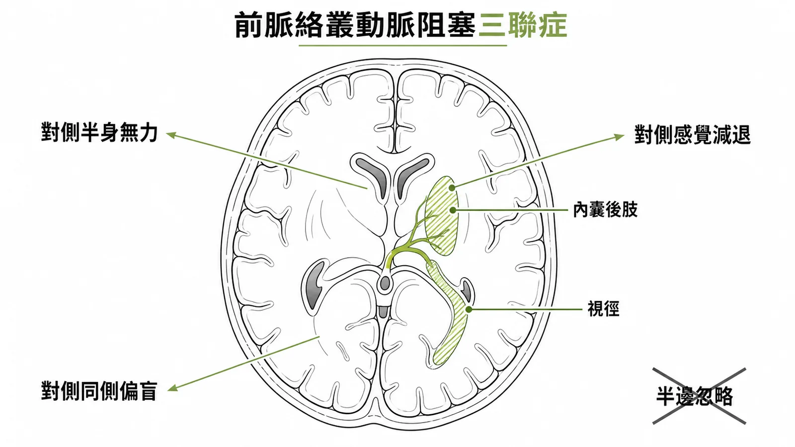 前脈絡叢動脈阻塞三聯症：半身無力、感覺減退、偏盲，不含半邊忽略