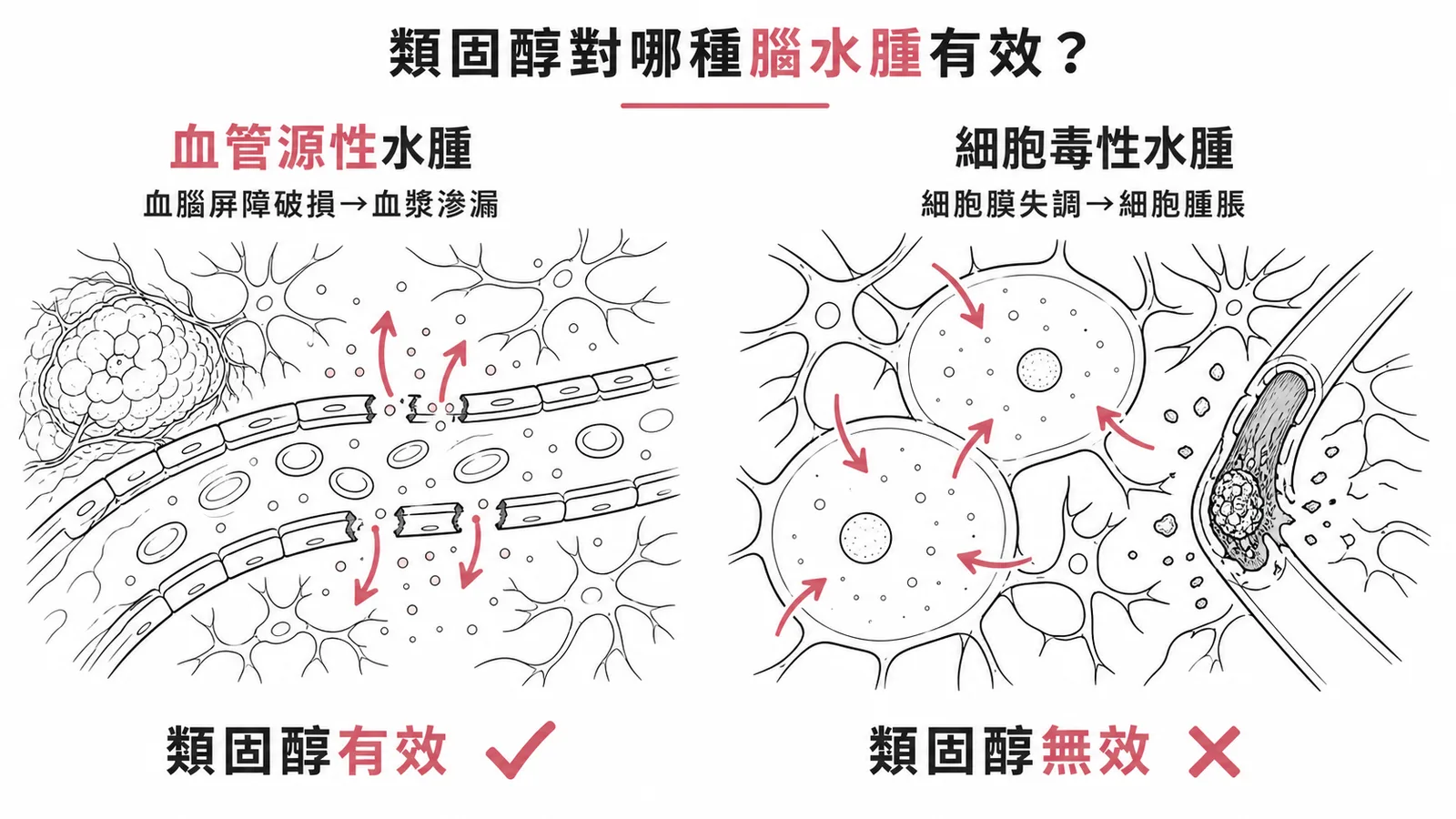 類固醇對血管源性水腫有效，對細胞毒性水腫無效