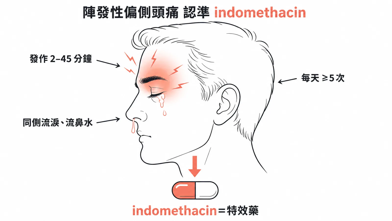 陣發性偏側頭痛認準 indomethacin:發作 2-45 分鐘、每天至少 5 次