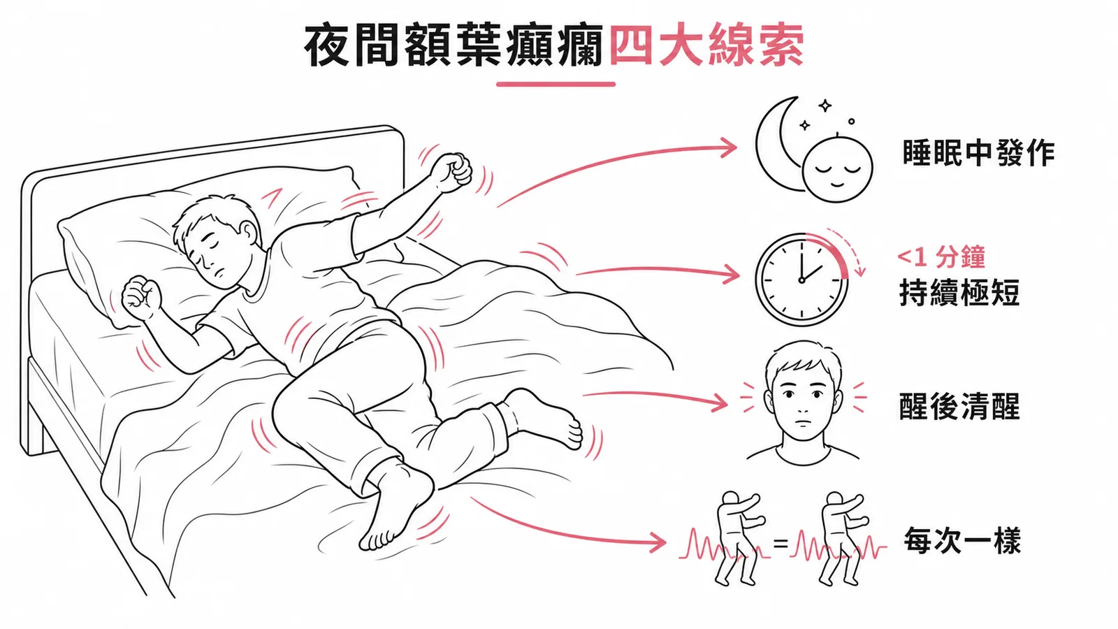 夜間額葉癲癇四大辨識線索：睡眠中發作、極短、醒後清醒、每次一樣