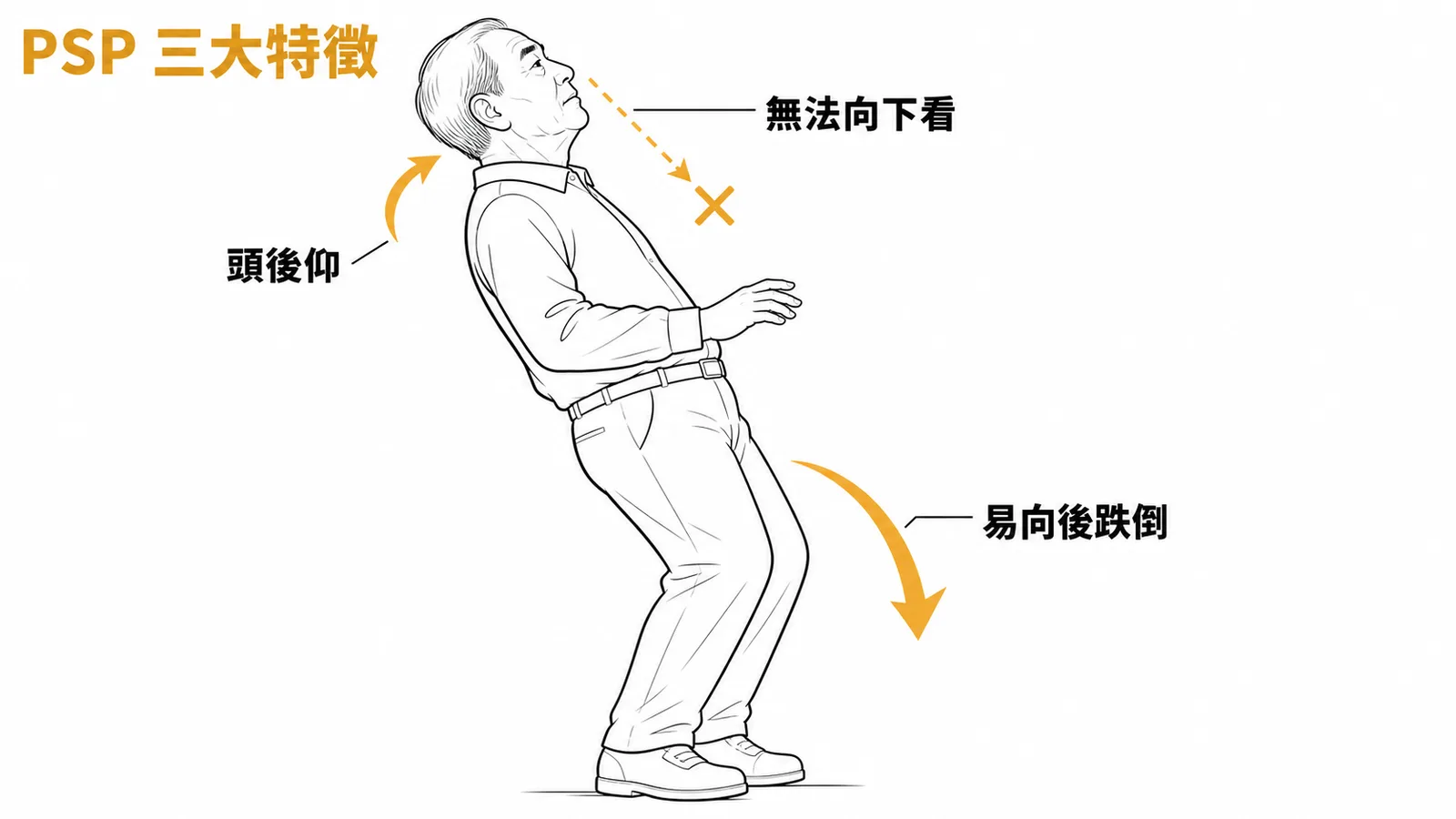 PSP 三大特徵:無法向下看、頭後仰、易向後跌倒