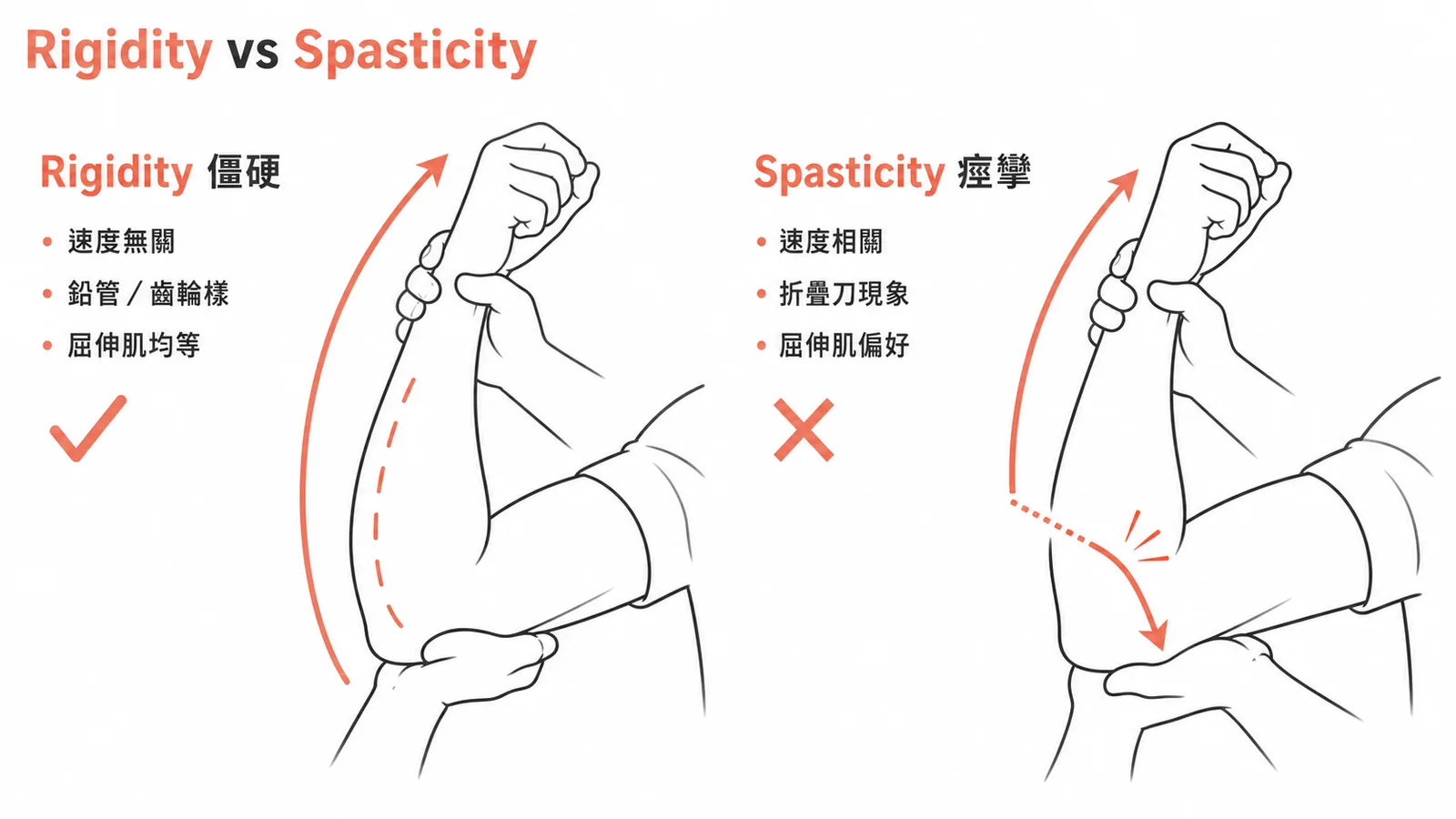 Rigidity(速度無關、鉛管齒輪樣)vs Spasticity(速度相關、折疊刀現象)