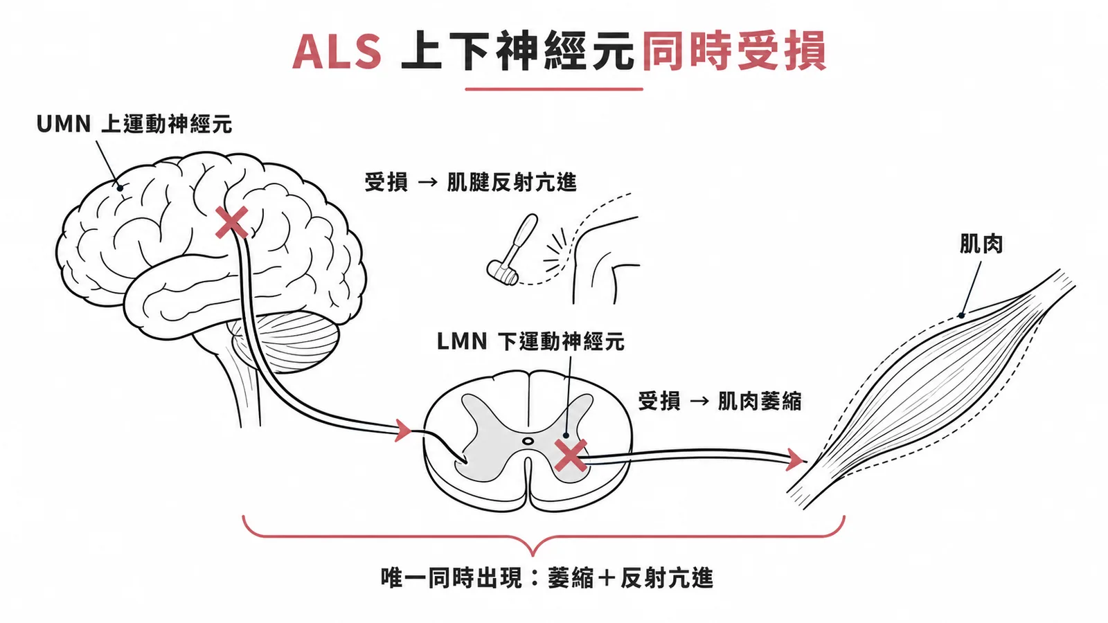 ALS 上下運動神經元同時受損：UMN 損傷致肌腱反射亢進、LMN 損傷致肌肉萎縮