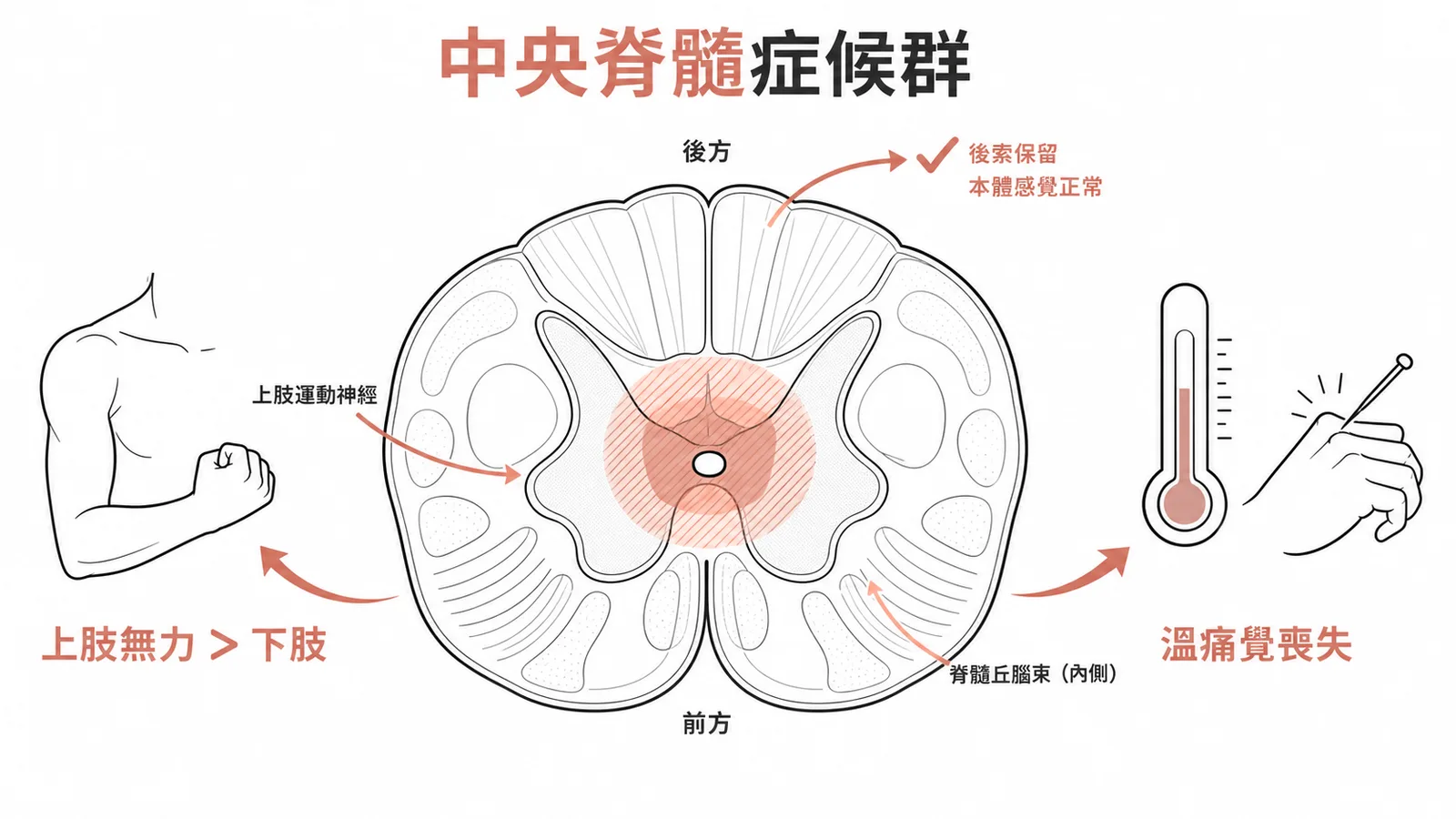 中央脊髓症候群:脊髓中央損傷致上肢無力大於下肢、溫痛覺喪失但本體感覺保留