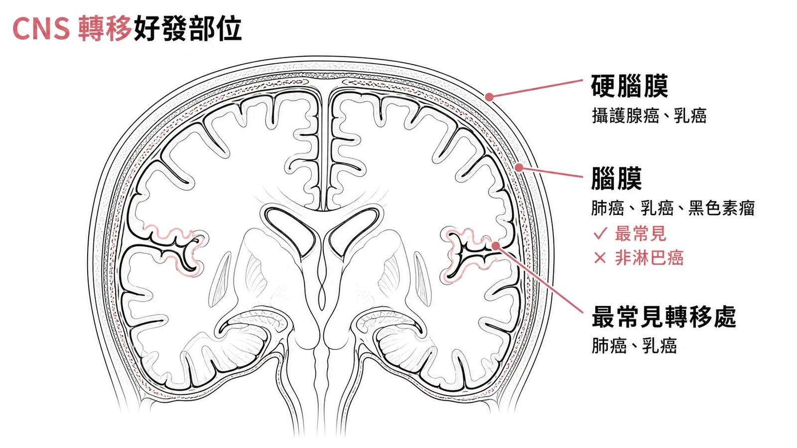 CNS 轉移好發部位：灰白質交界（最常見）、腦膜（肺癌乳癌黑色素瘤）、硬腦膜（攝護腺癌乳癌）