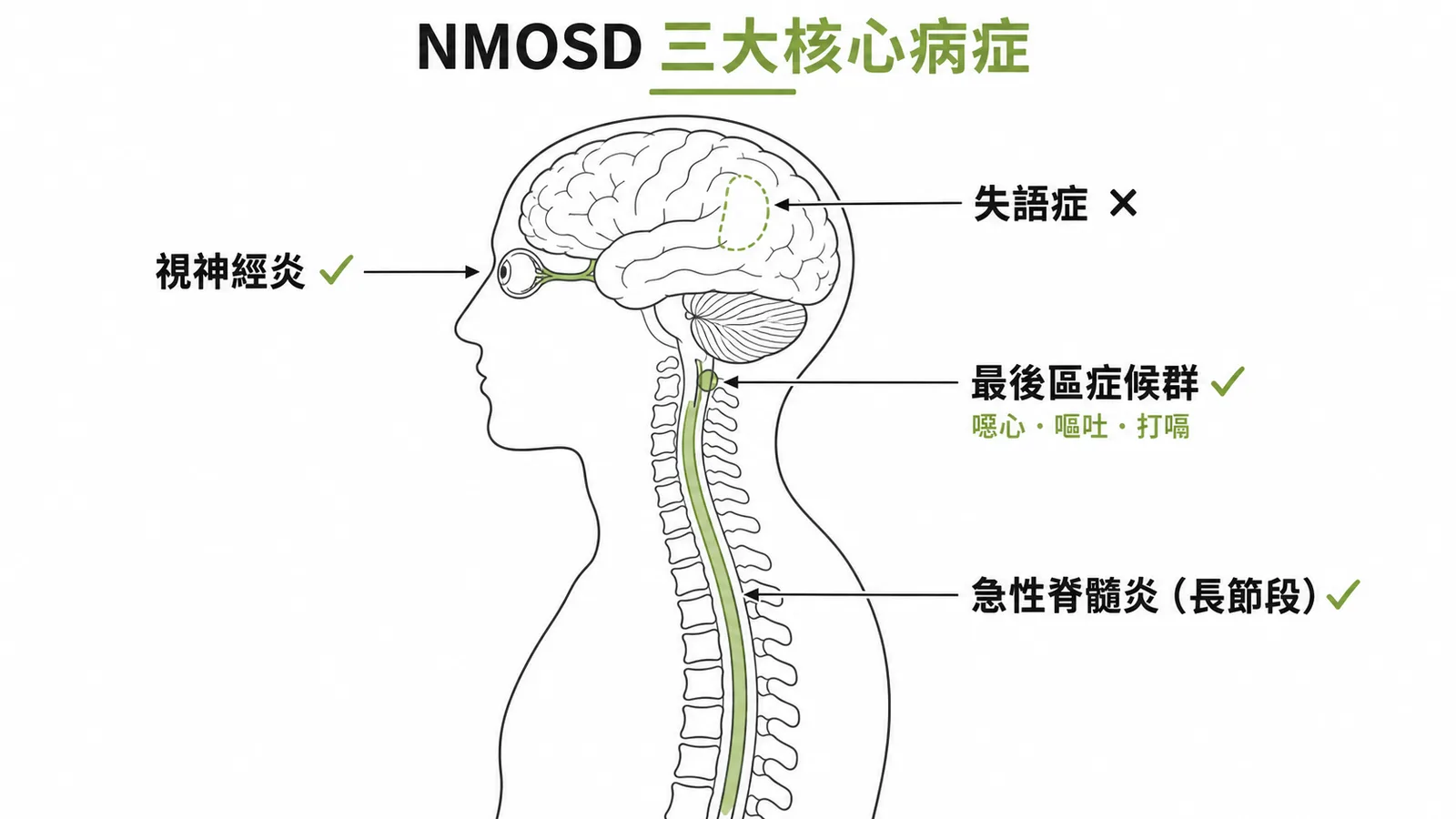 NMOSD 三大核心病症：視神經炎、最後區症候群、急性脊髓炎；失語症非核心病症