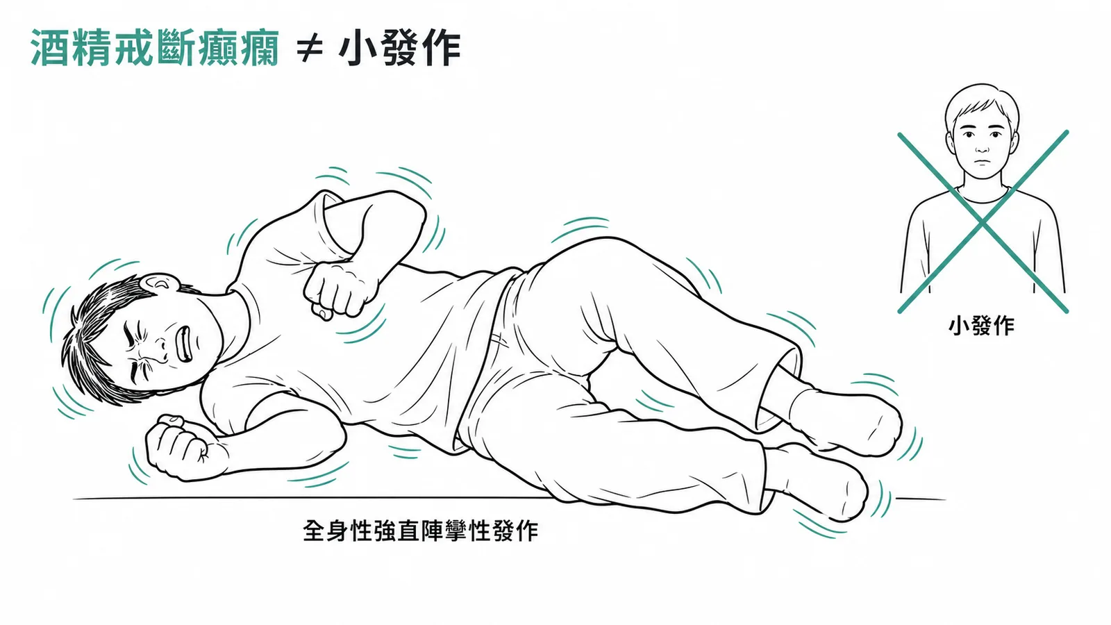 酒精戒斷癲癇為全身性強直陣攣性大發作，並非小發作