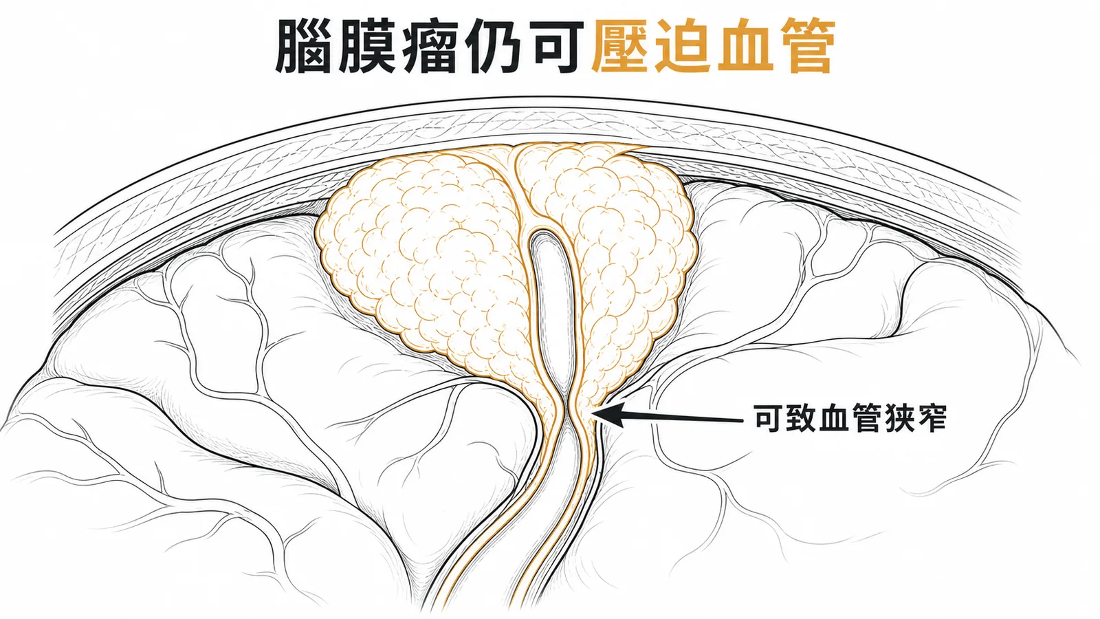 腦膜瘤雖生長緩慢，包圍血管時仍可造成血管狹窄