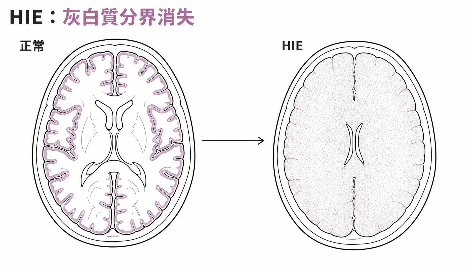 缺氧缺血性腦病變CT表現：灰白質分界消失、腦溝變淺