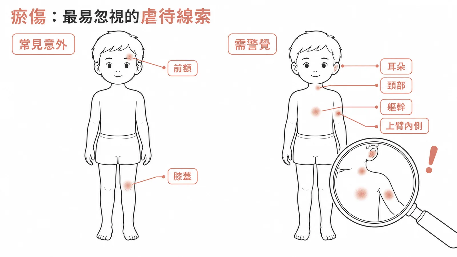 瘀傷是最易被忽視的兒童虐待線索，需注意非典型部位