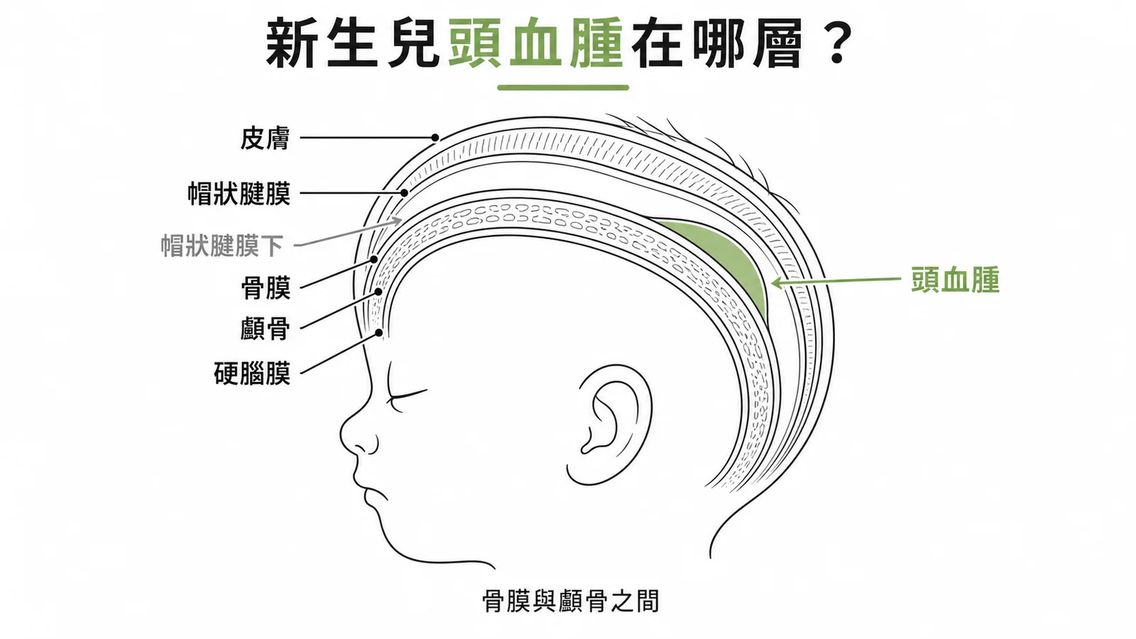 新生兒頭部產傷三層出血位置:帽狀腱膜下出血最危險