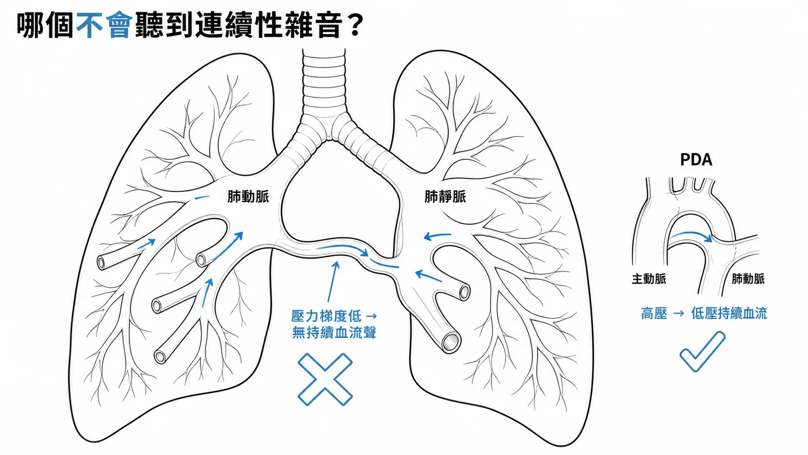 肺動脈-肺靜脈瘻管最不會出現連續性心雜音