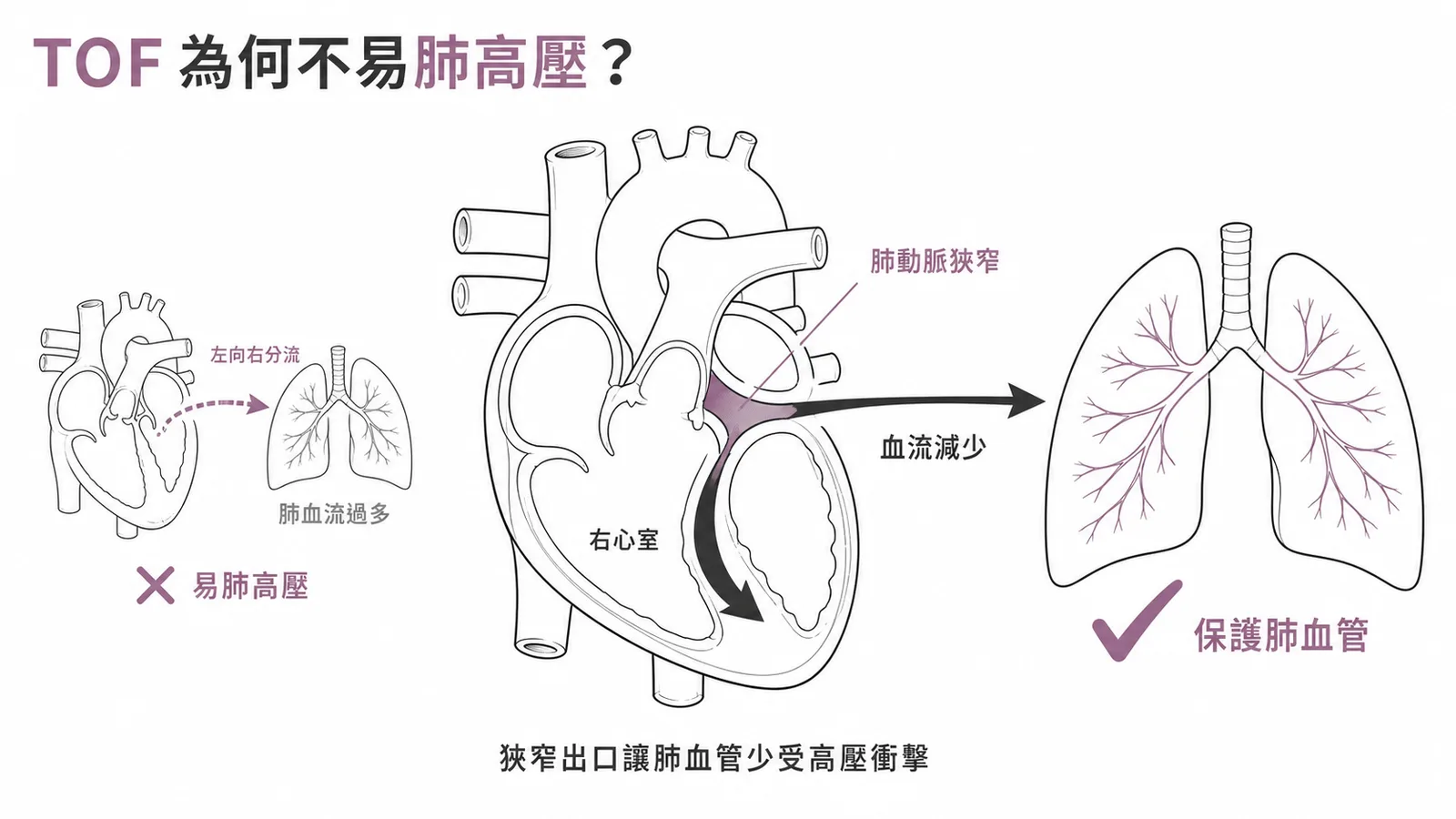 法洛氏四重症的肺動脈狹窄保護肺血管免於高壓