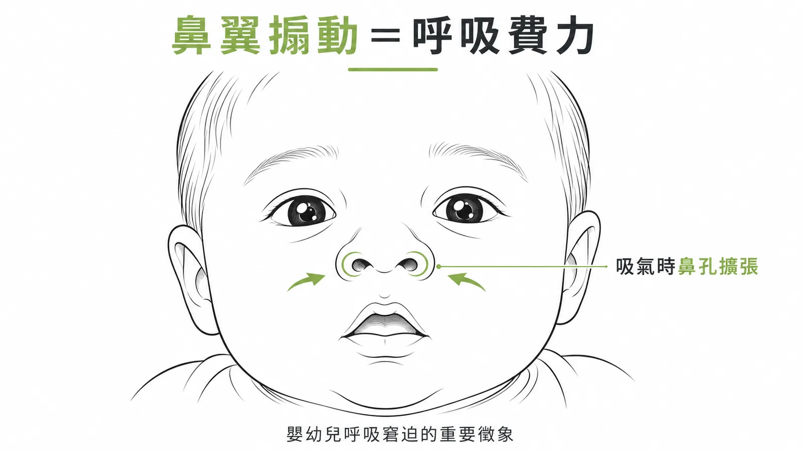 嬰兒呼吸窘迫時鼻翼搧動的示意圖