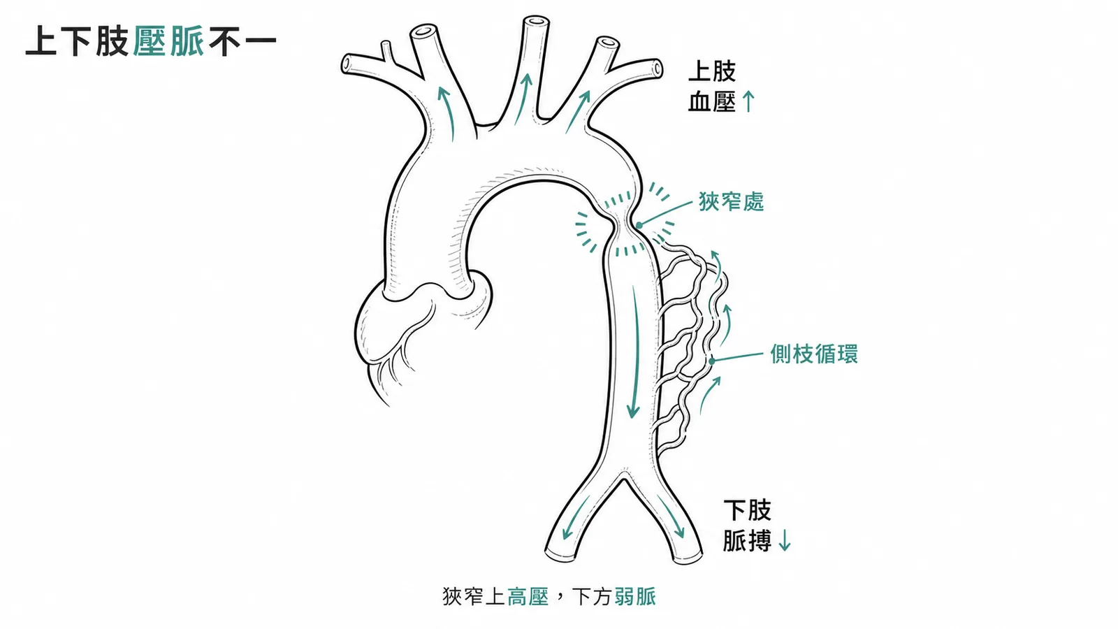 主動脈弓縮窄導致上肢高血壓下肢脈搏弱示意圖