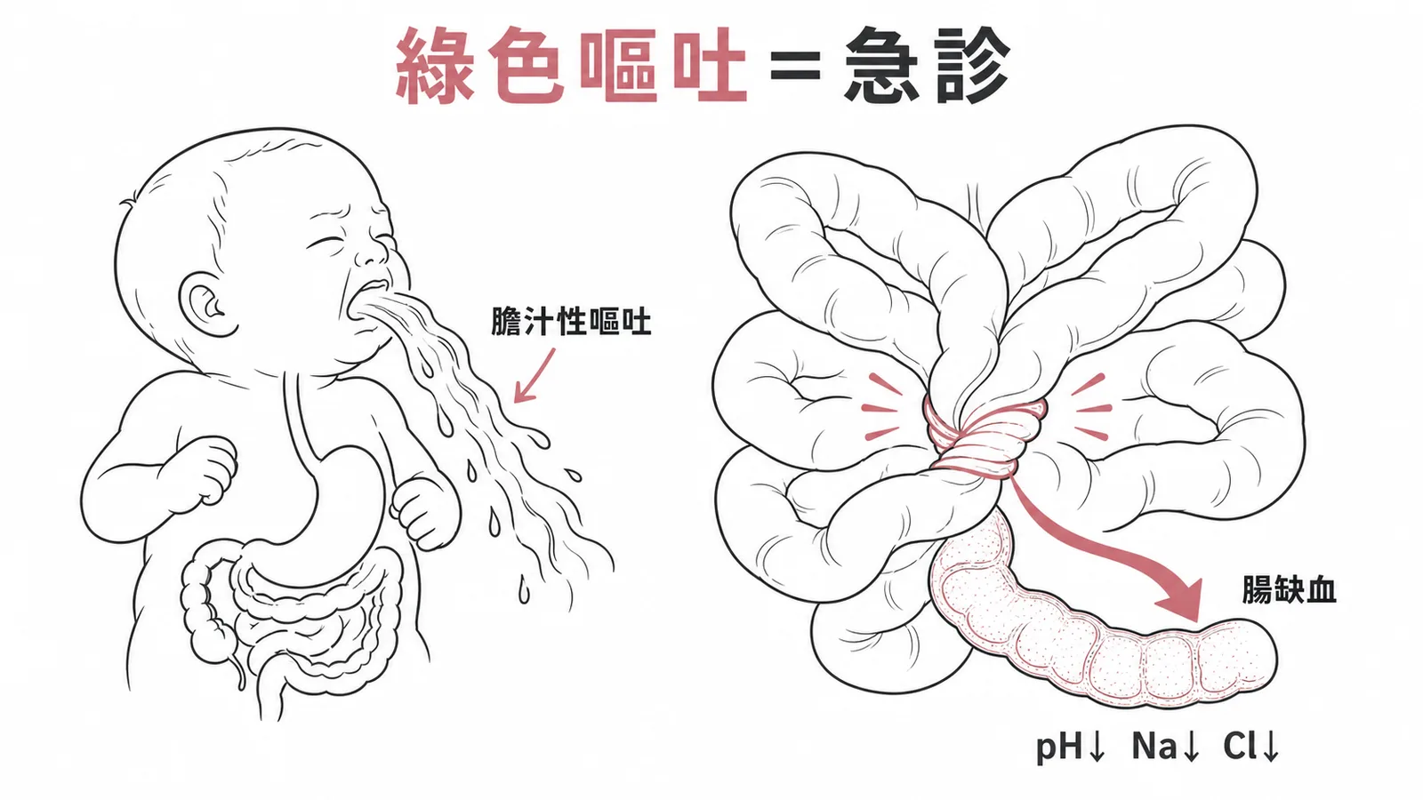 嬰兒中腸扭結導致綠色嘔吐與代謝性酸中毒流程圖